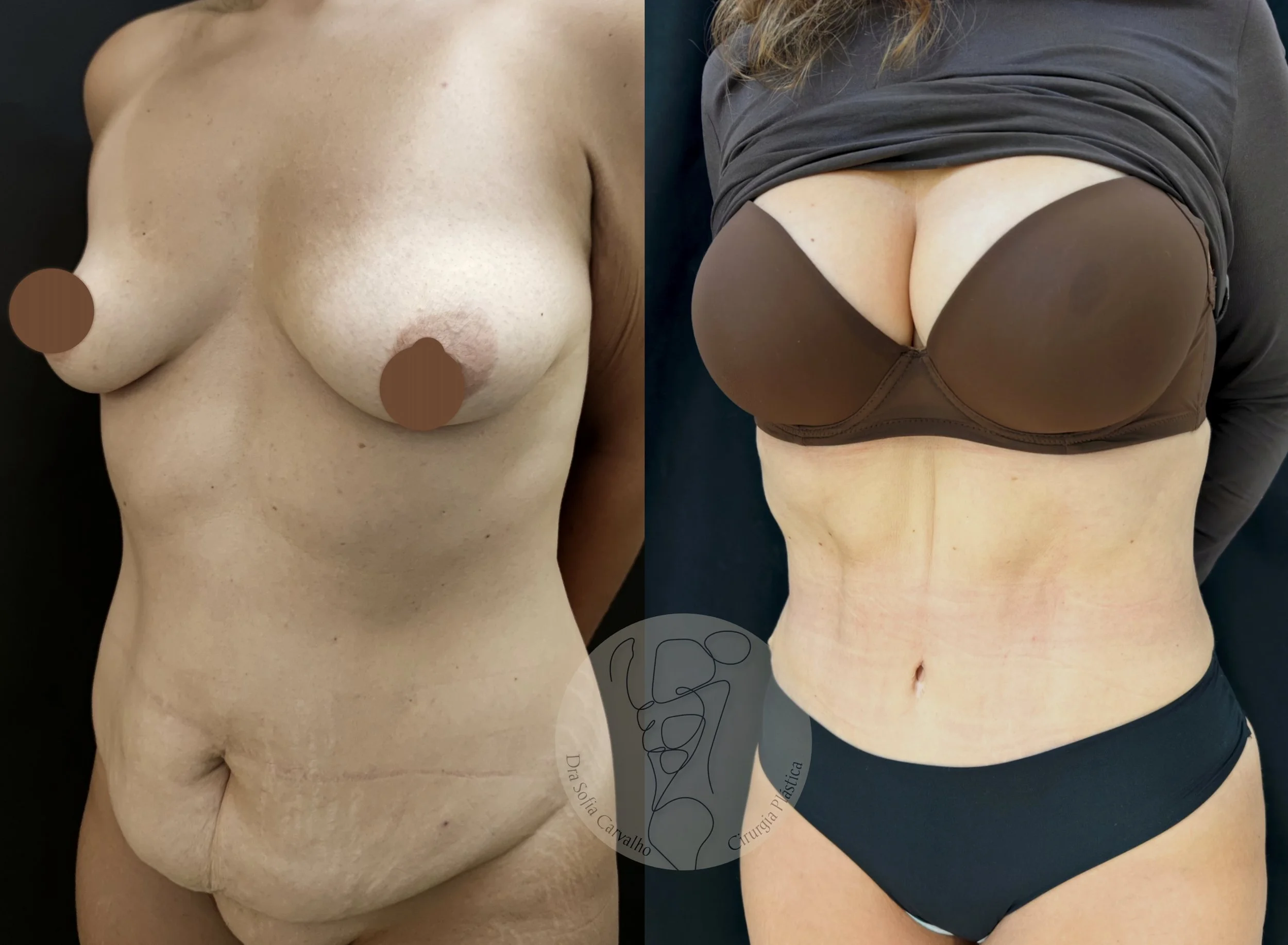 Imagem dividida ao meio, mostrando uma mulher nua à esquerda com os seios cobertos por círculos marrons e sem roupa abaixo da cintura, e uma mulher à direita usando vestido de renda marrom e calcinha preta, com o abdômen exposto.