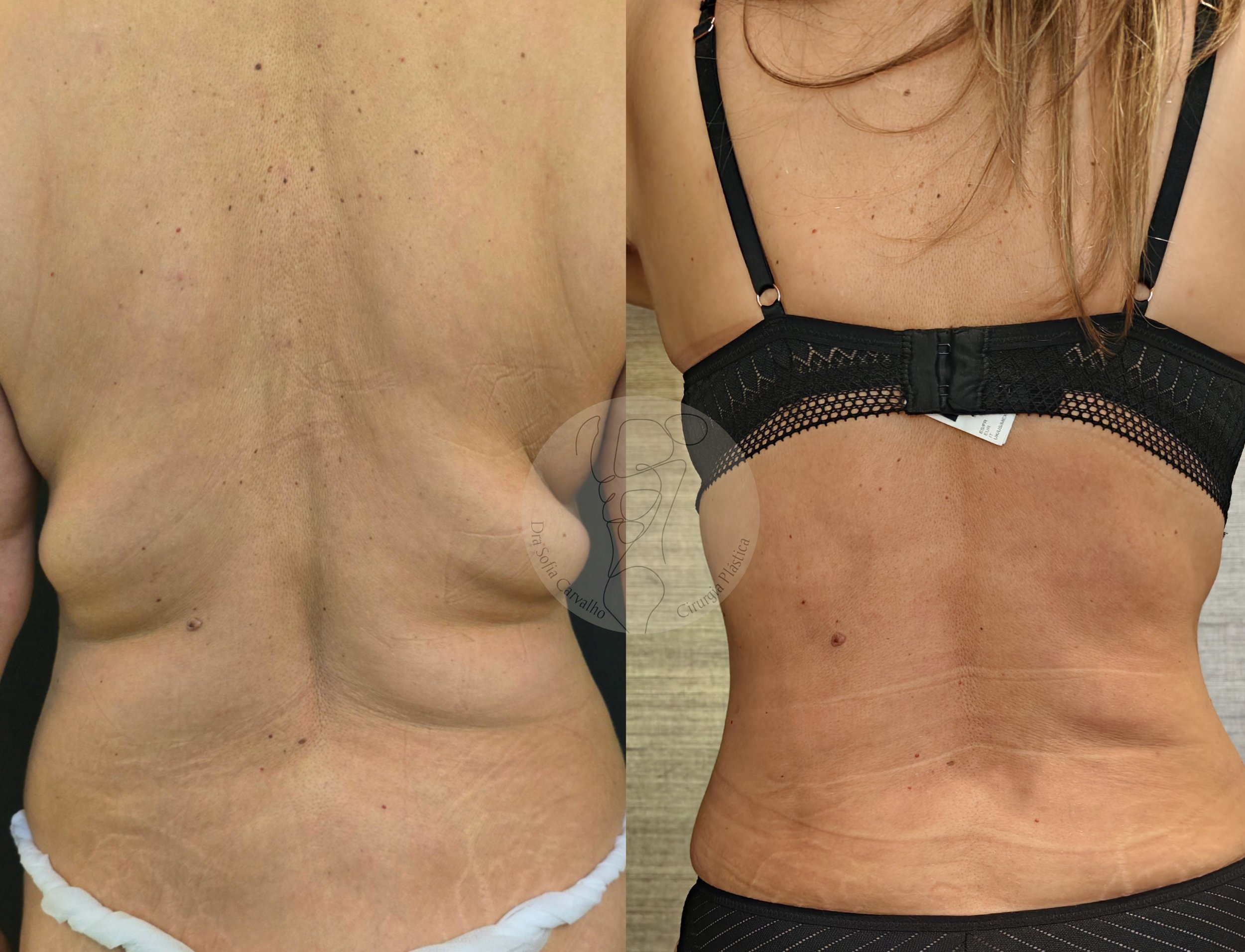 renuvion flacidez flancos e costas