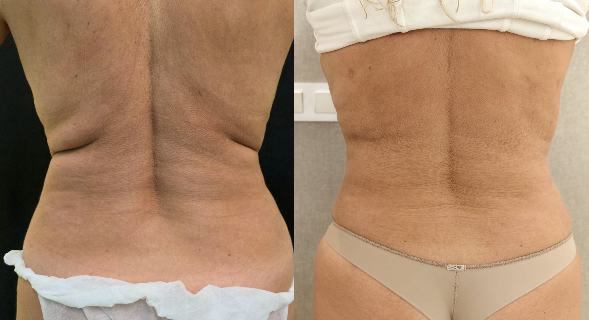 lipolaser costas e flancos