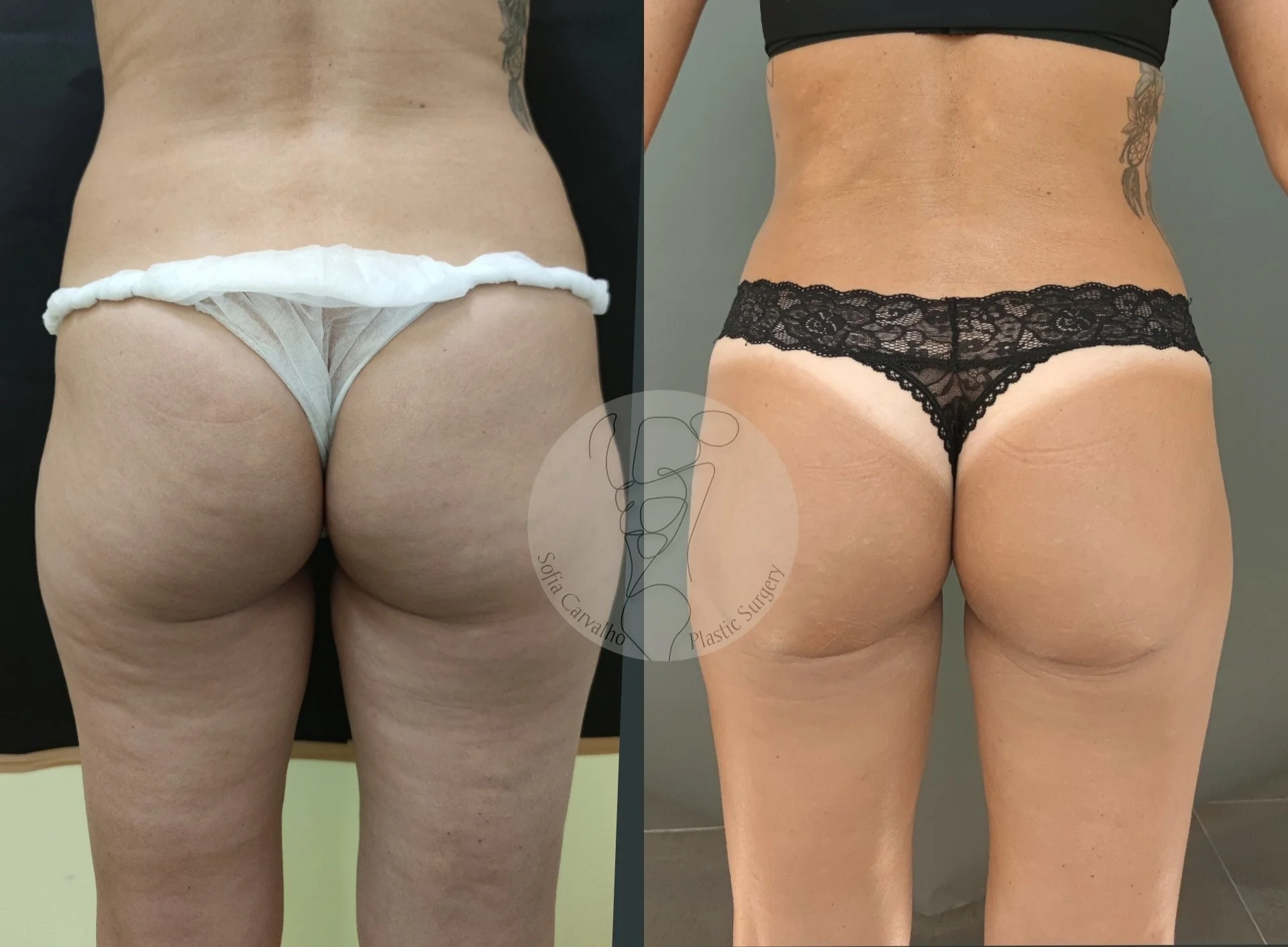 antes e depois de celulite