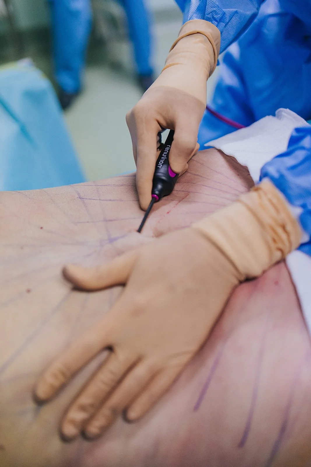 Médico realizando uma cirurgia na barriga de um paciente, com marcas na pele e usando luvas de látex. O médico está usando uma ferramenta de precisão para marcar ou fazer uma incisão.