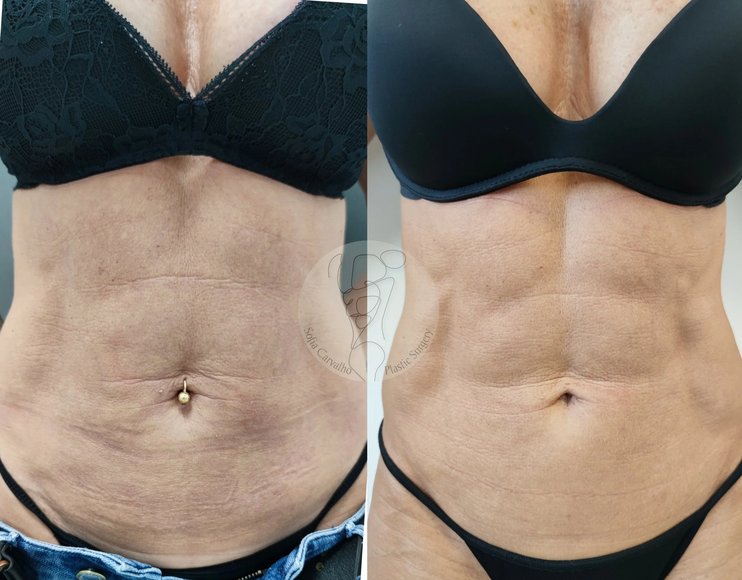 antes e depois lipo HD e renuvion