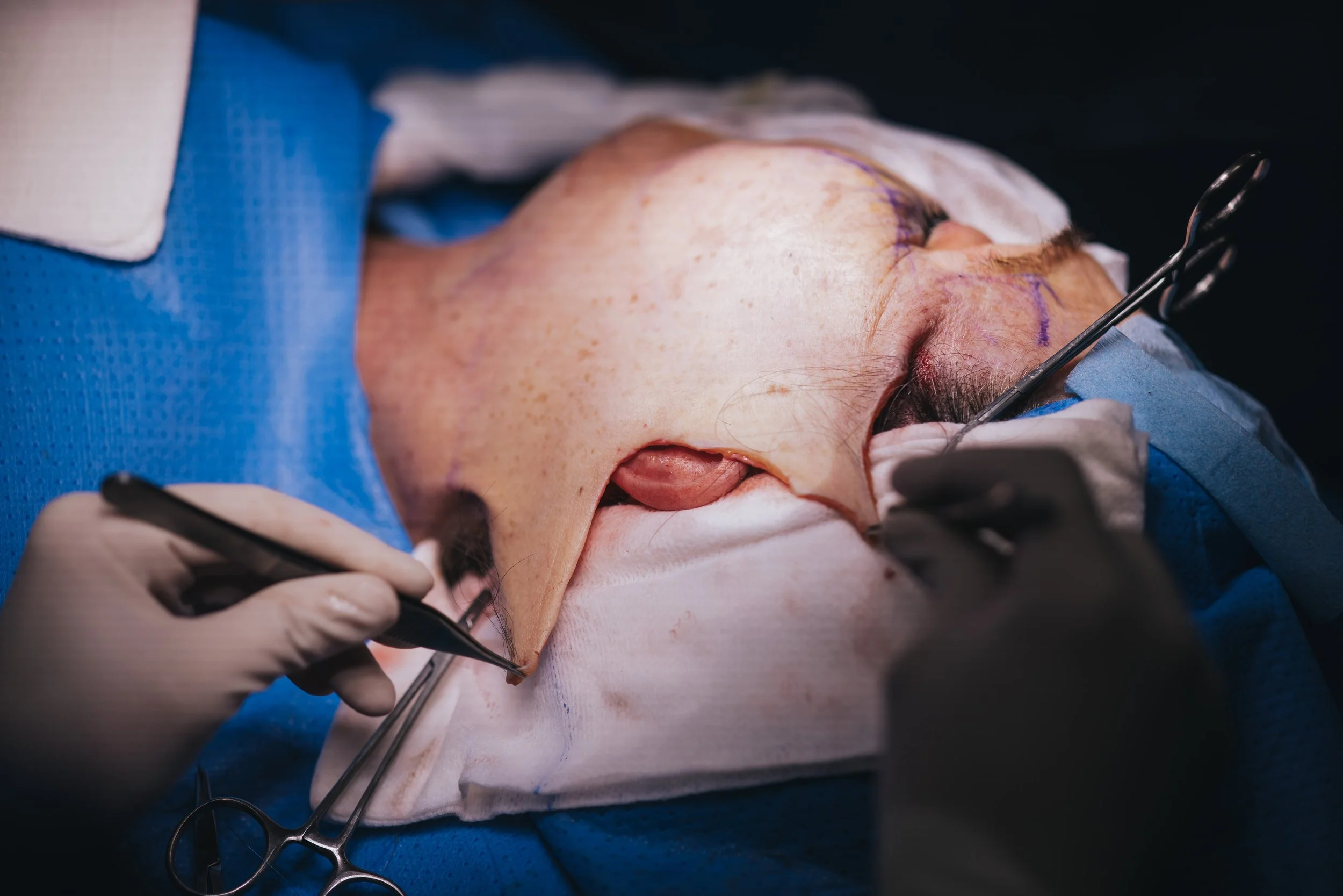 os tecidos são reposicionados e o excesso de pele removido