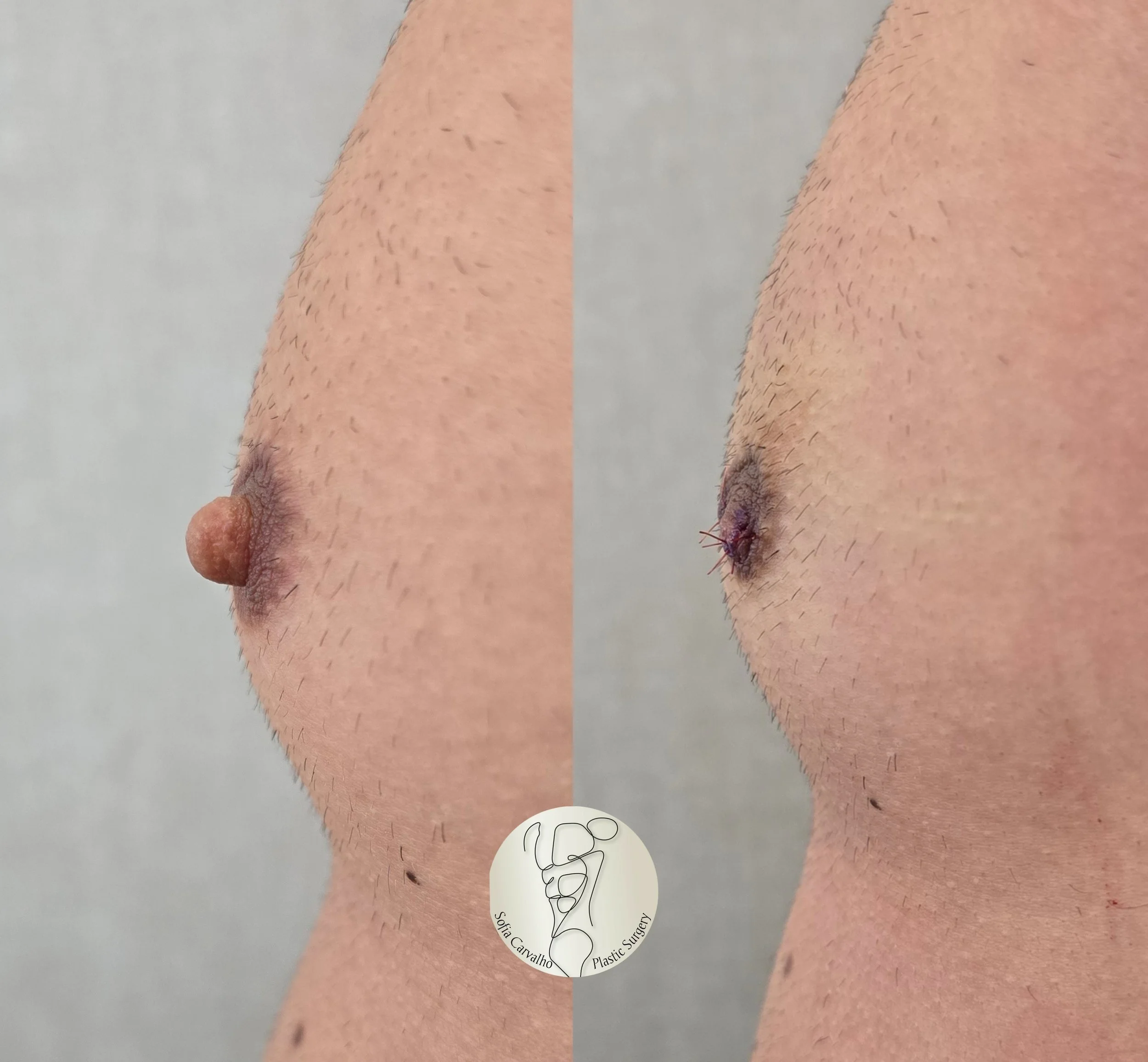 redução de mamilos antes e depois