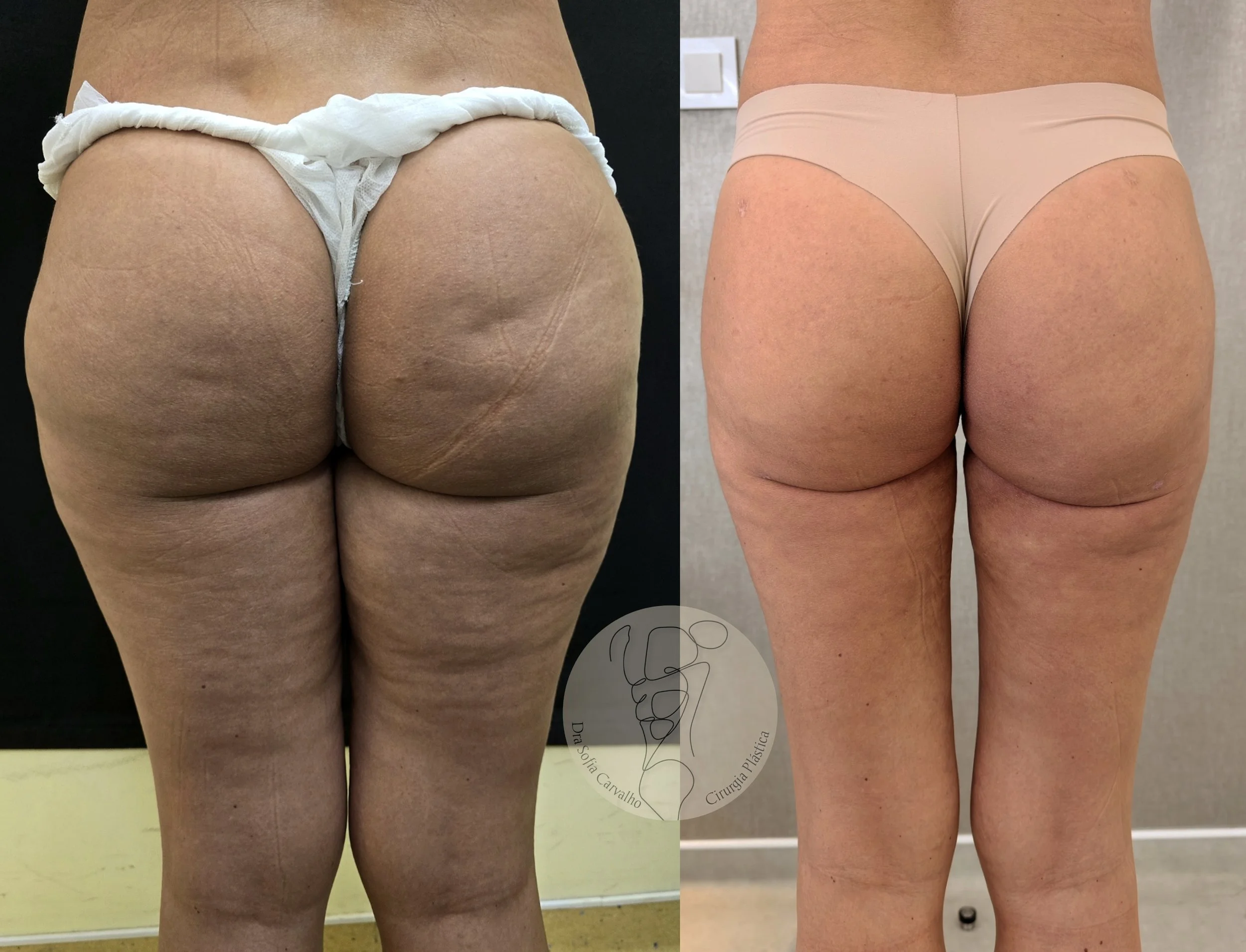 antes e depois de lipedema