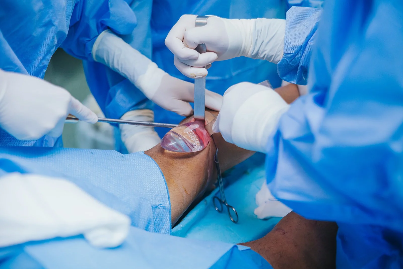 Equipe médica realizando cirurgia em braço com instrumentos cirúrgicos, usando luvas, aventais azuis e máscara.