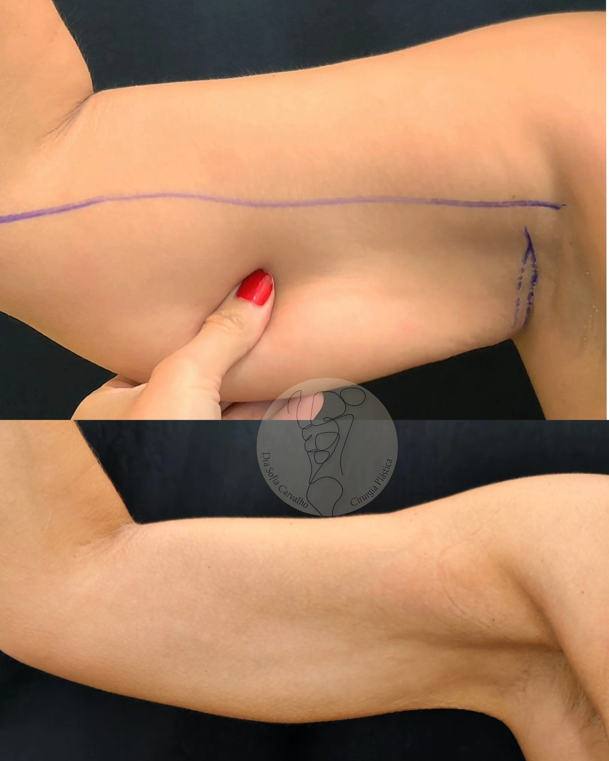 Lipo HD braços sem cicatriz