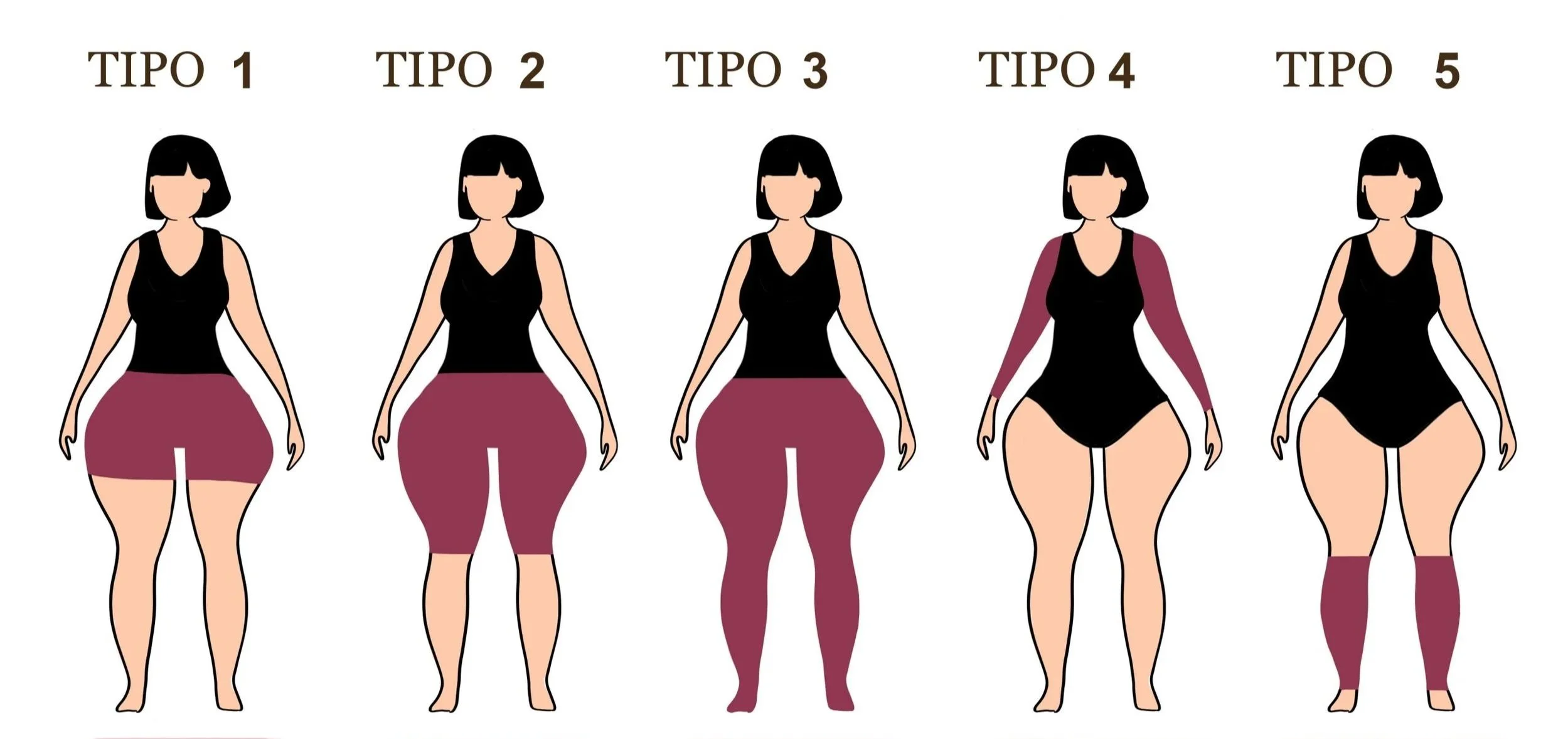 tipos de lipedema