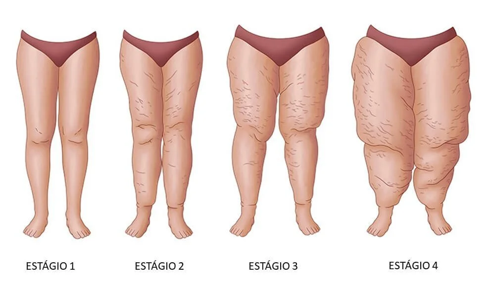 graus de lipedema