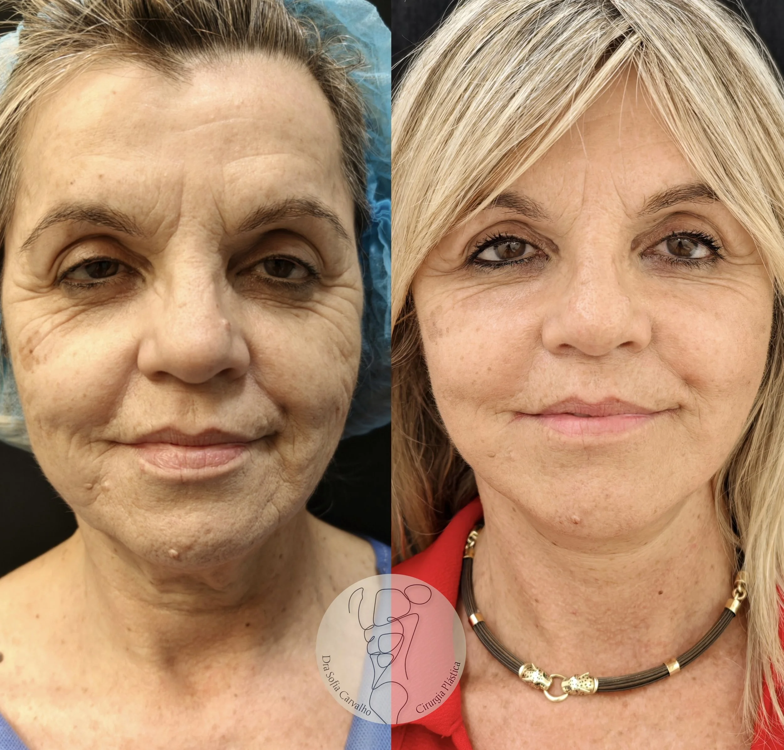 Lifting + nanofat para melhoria da qualidade da pele