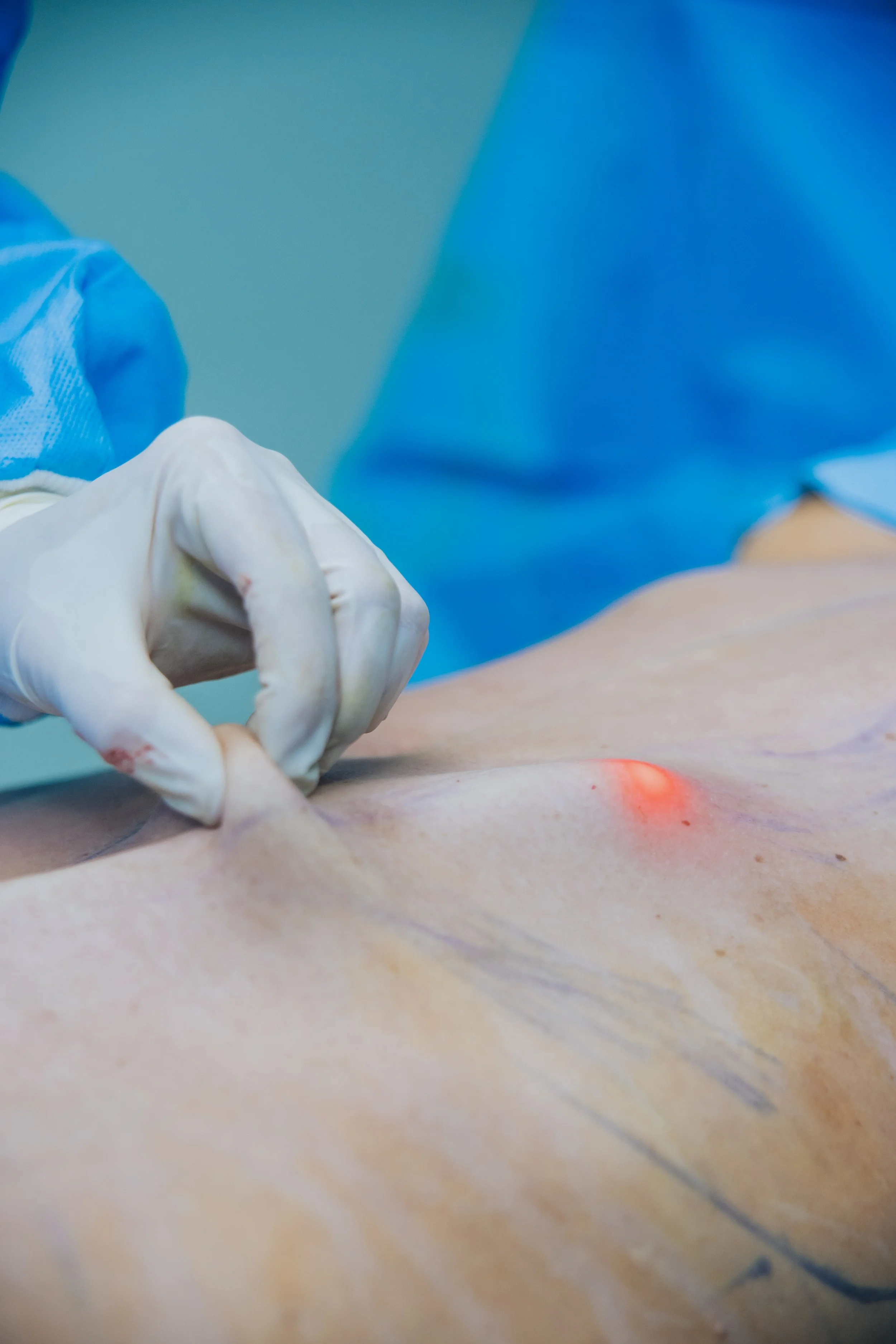 Lipo Hd com lipolaser