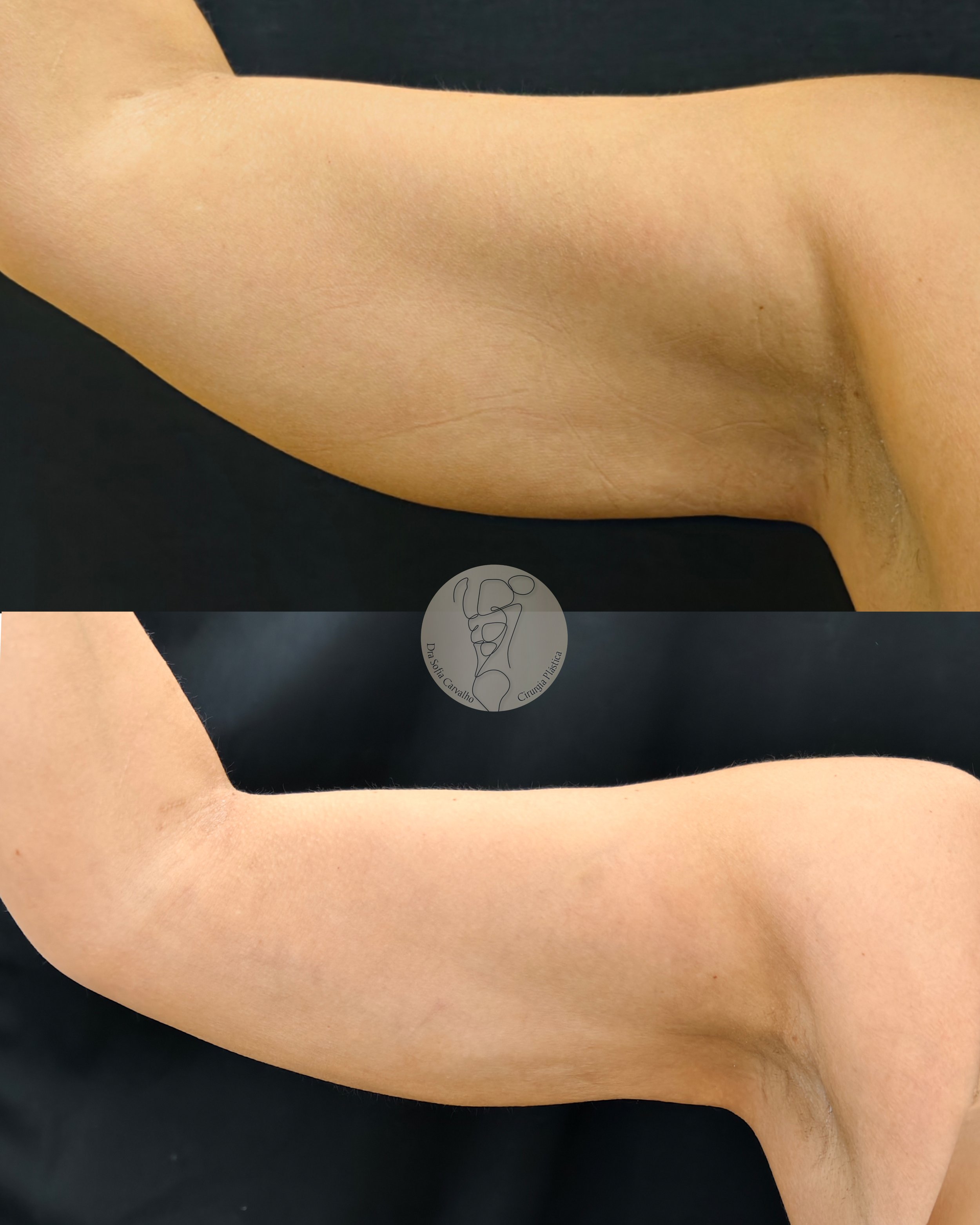 antes e depois lipo HD