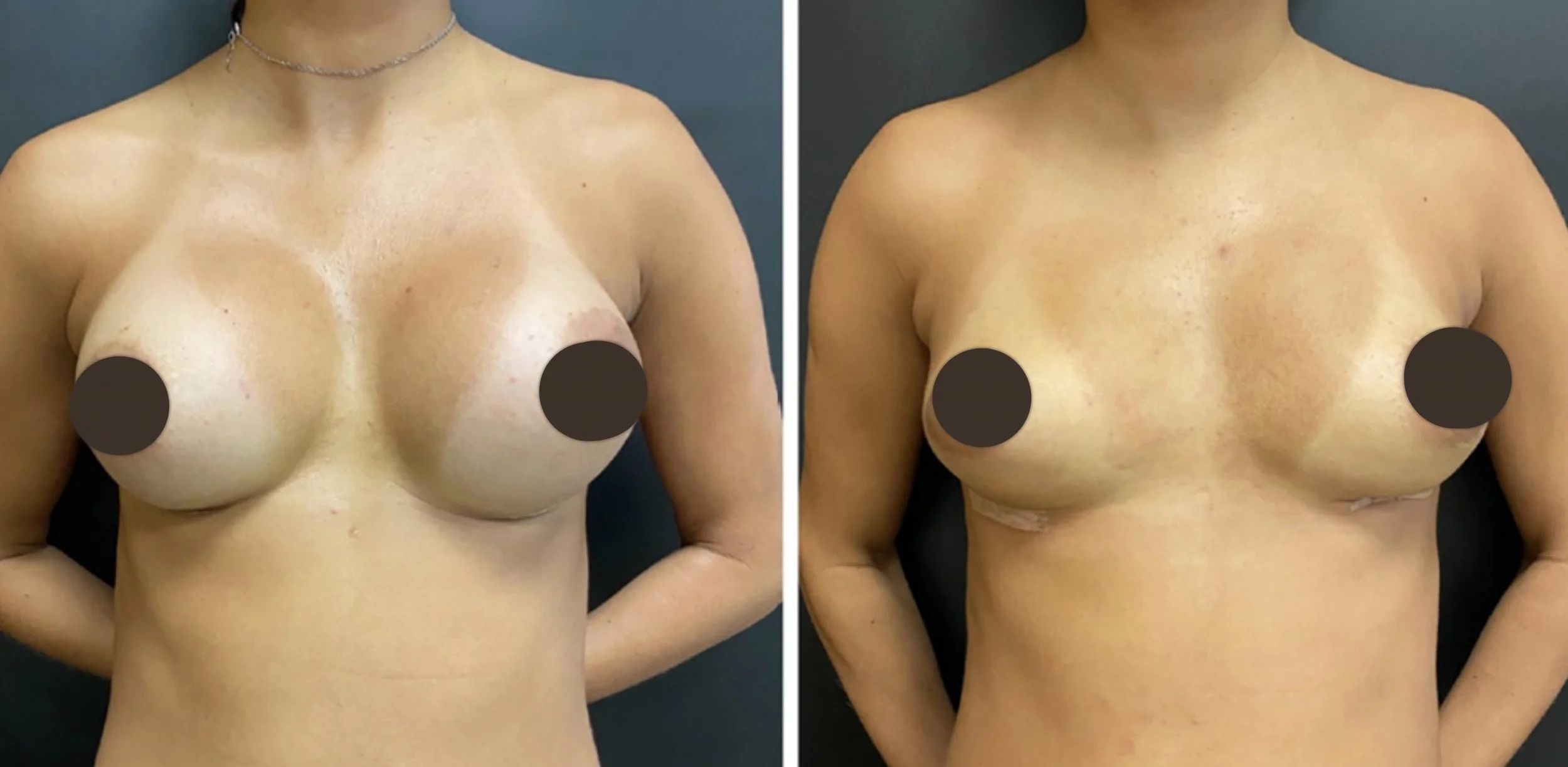 antes e depois de cirurgia de explante