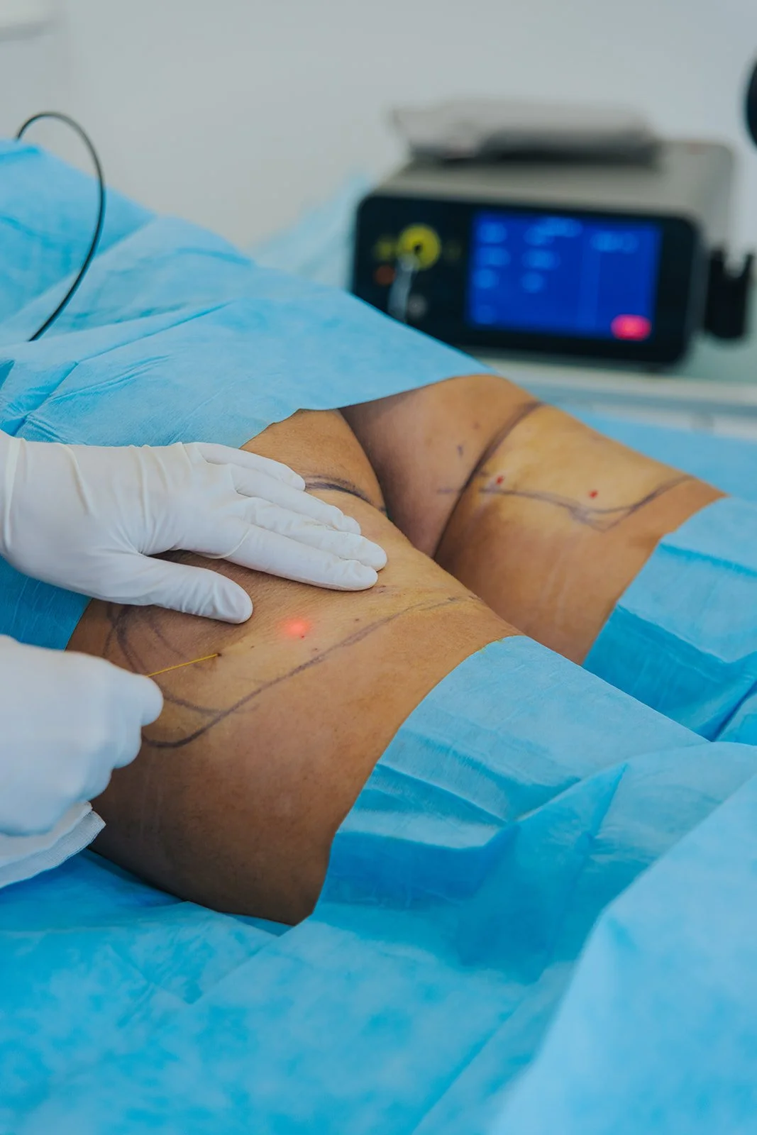 endolift para subcision da celulite