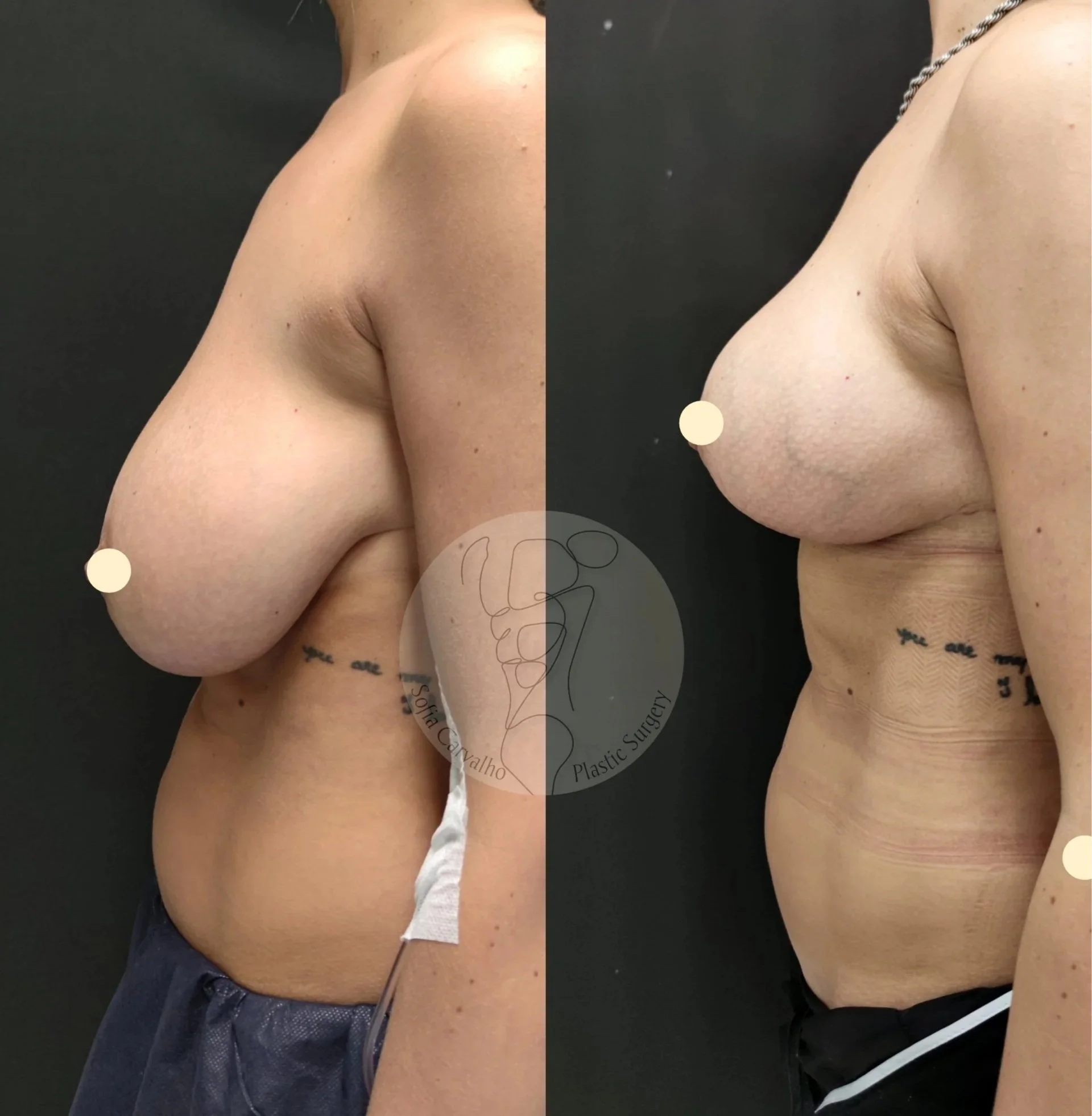 mamoplastia de redução antes e depois