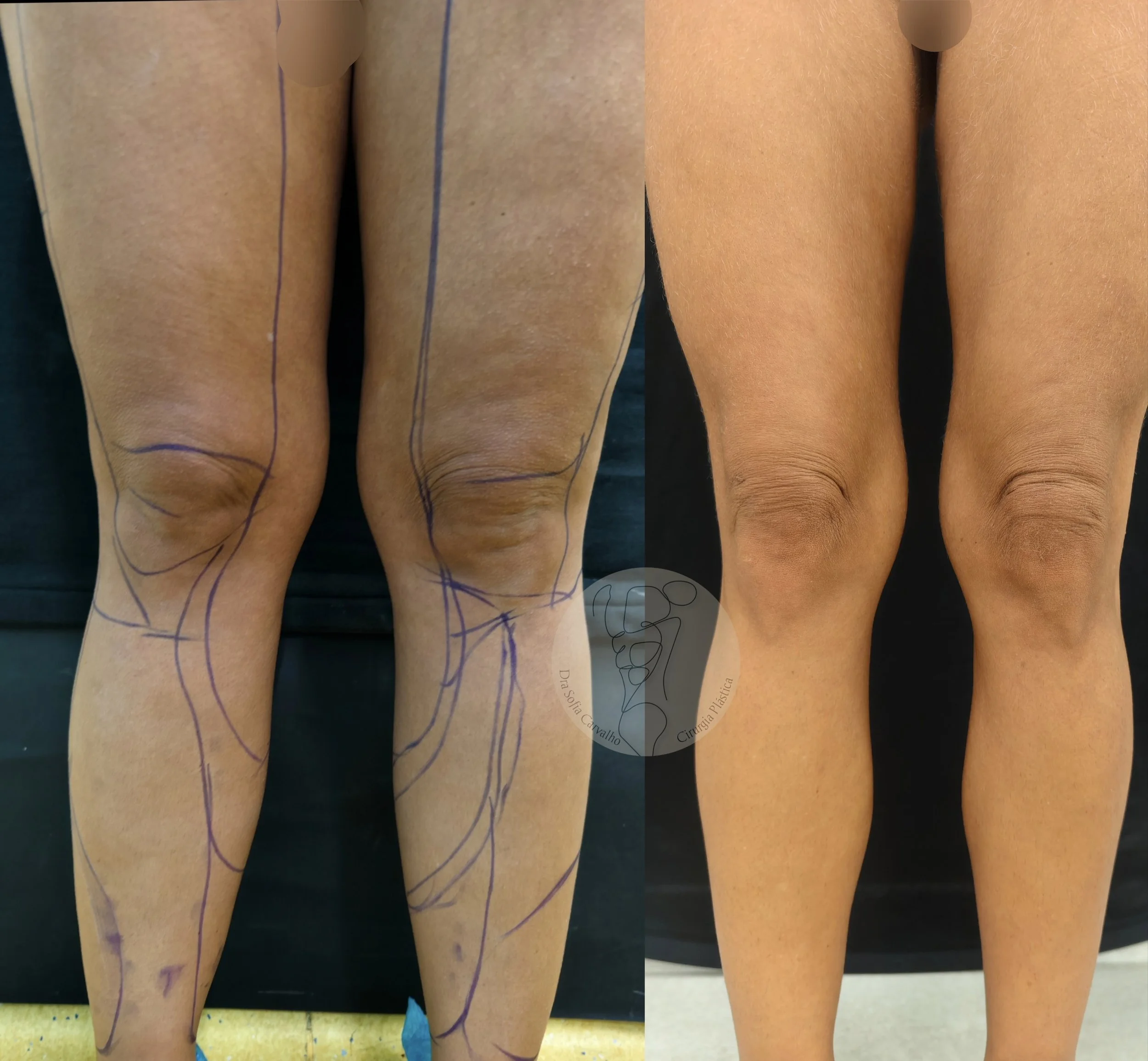 antes e depois lipedema
