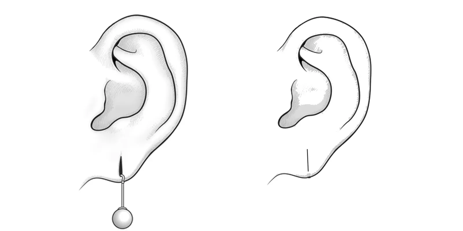 Ilustrações de orelhas humanas, uma com um dispositivo de ouvido e a outra sem.
