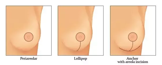 cicatrizes de mastopexia