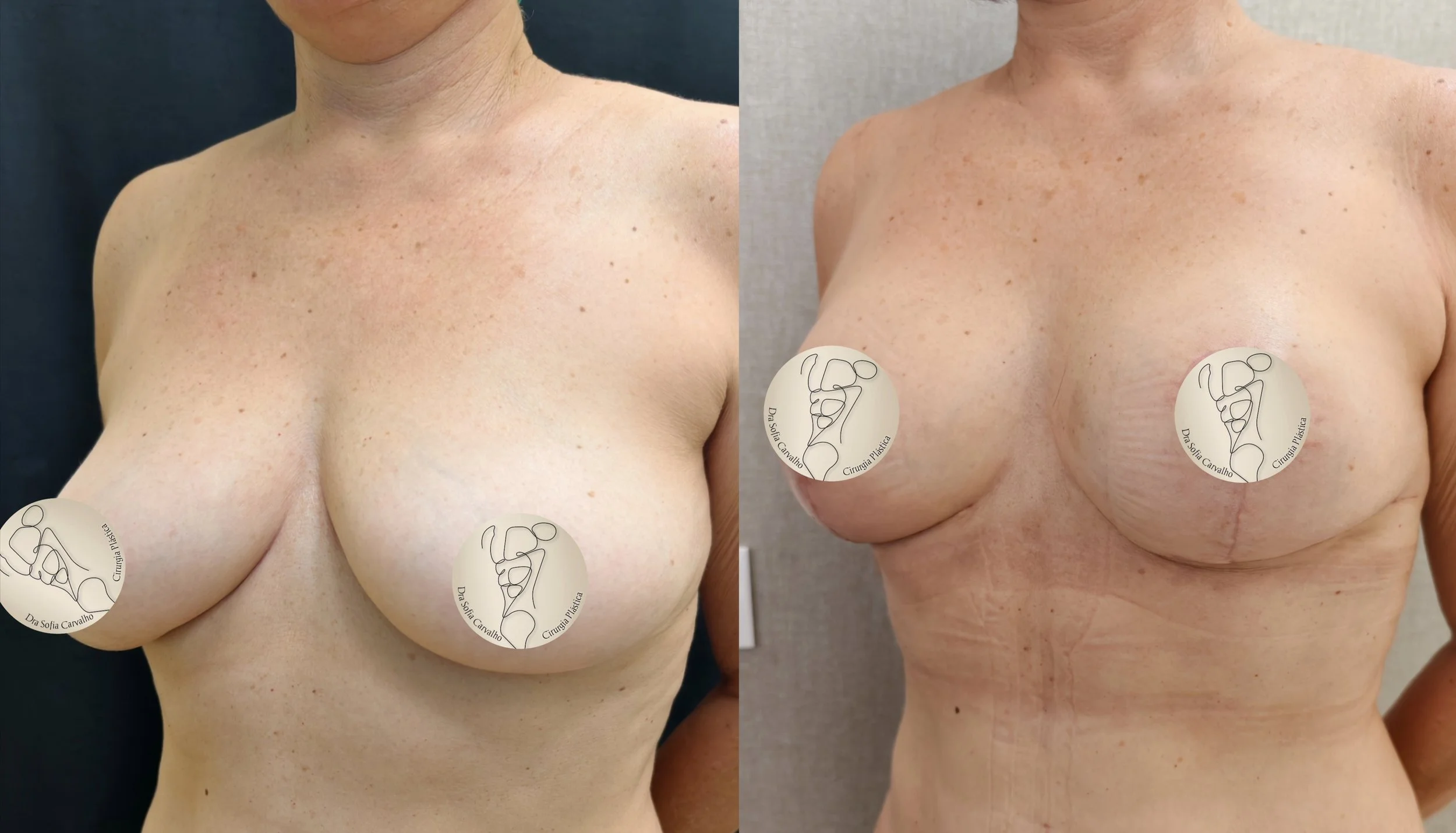 mastopexia sem próteses antes e depois