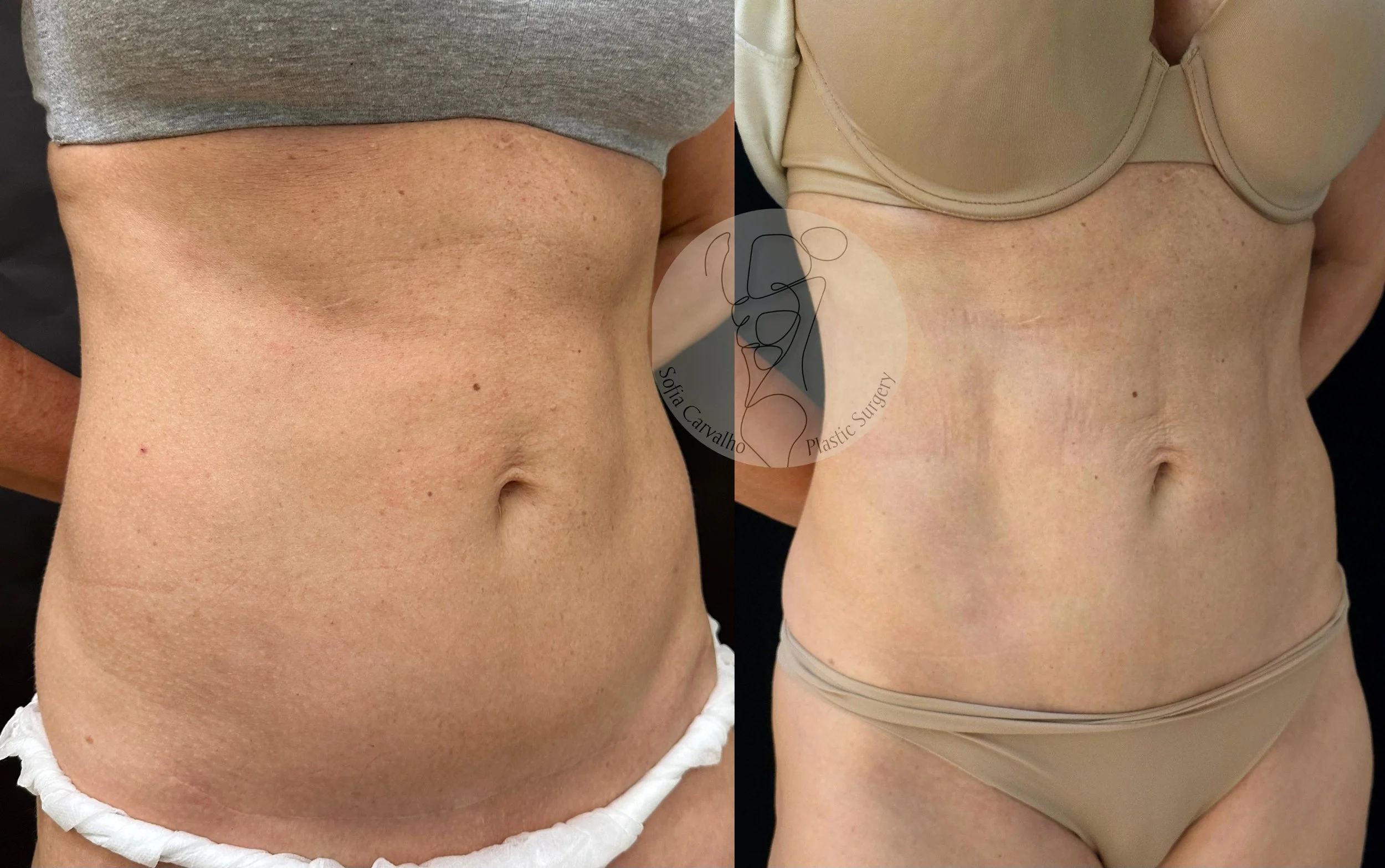 Antes e depois Lipo HD abdómen