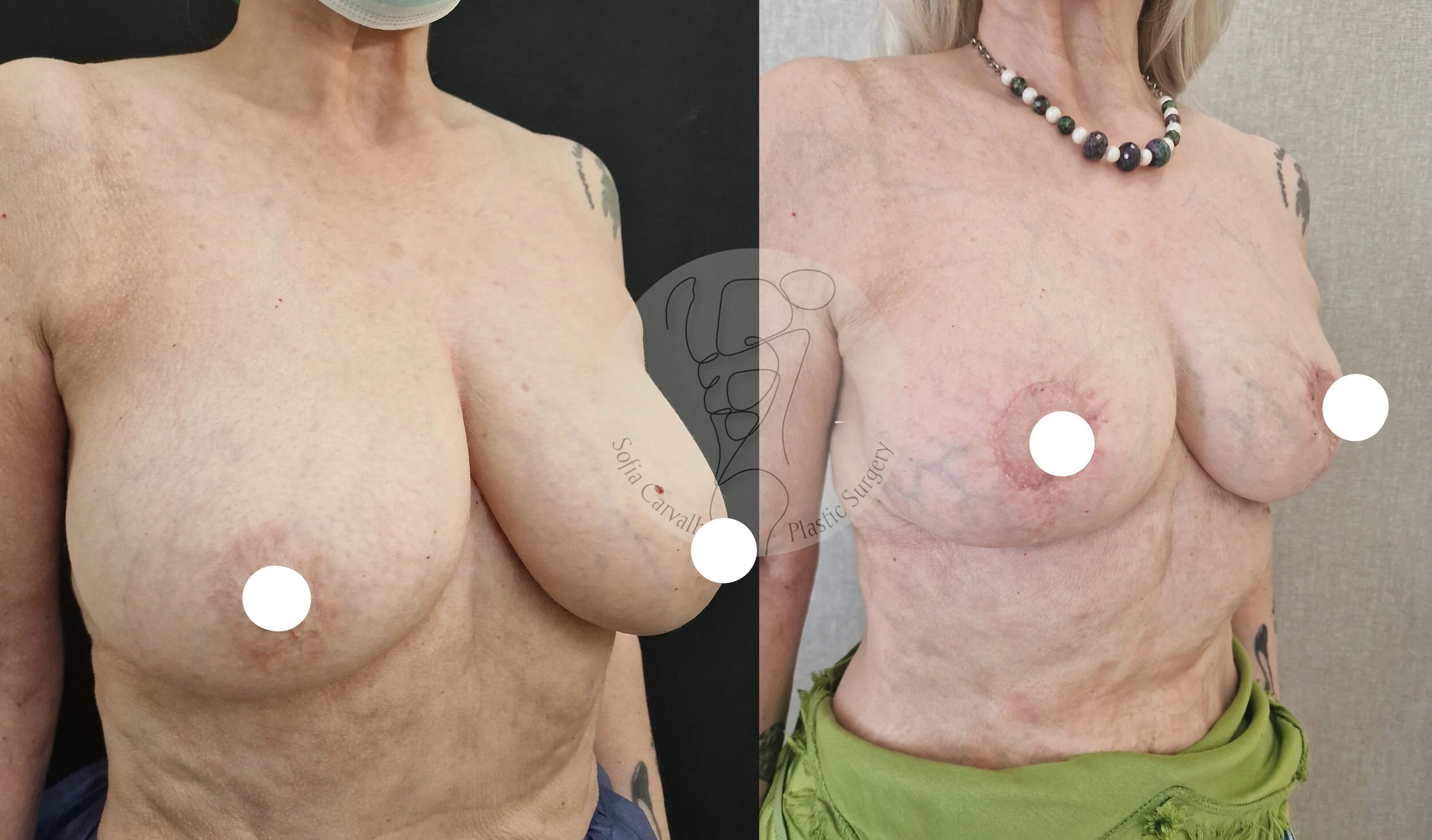 antes e depois mamoplastia de redução