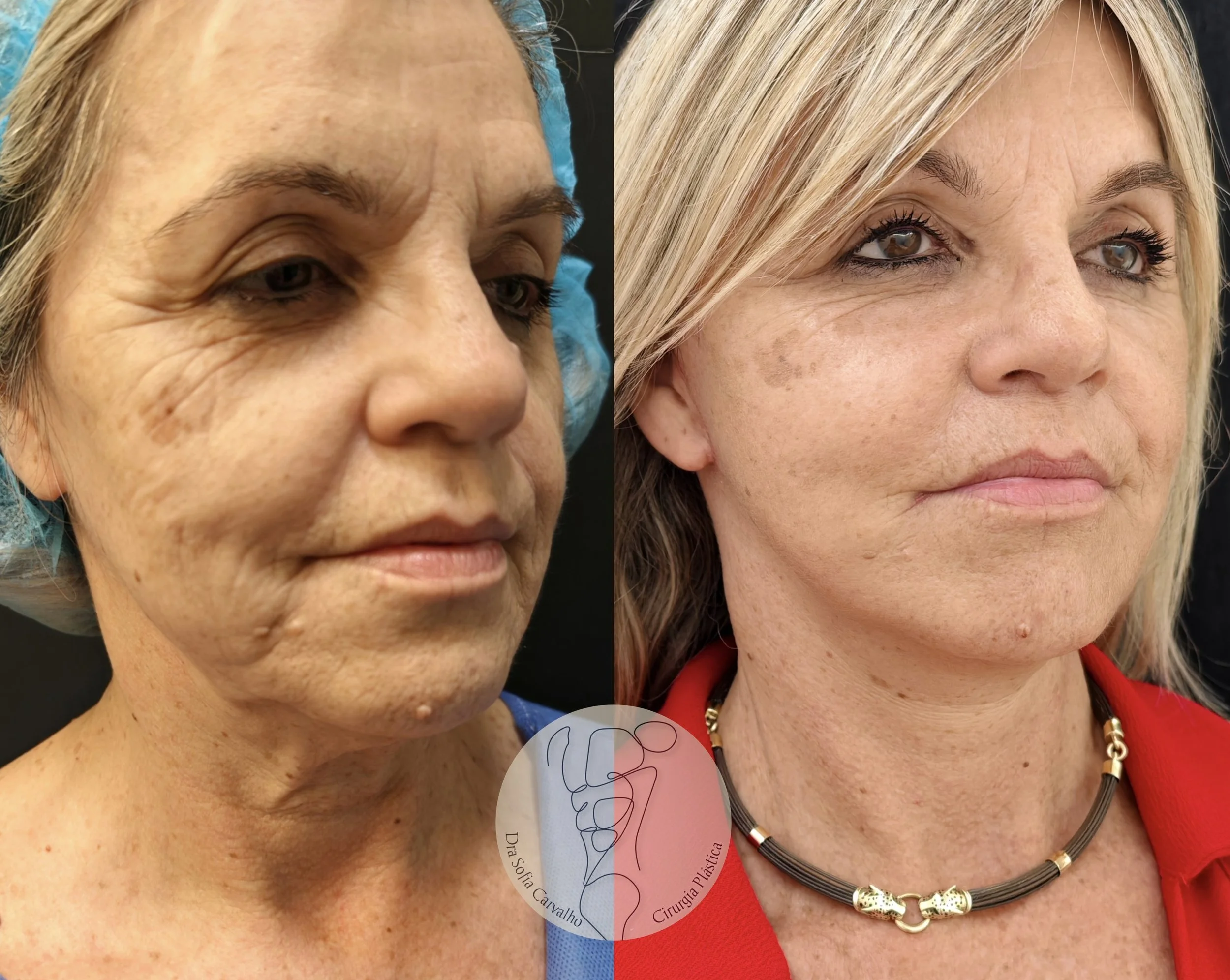 antes e depois facelift