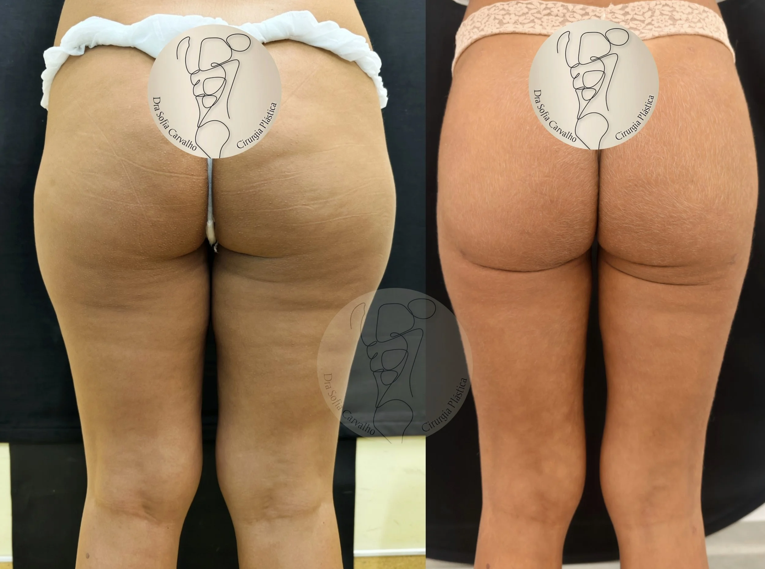 antes e depois de lipedema
