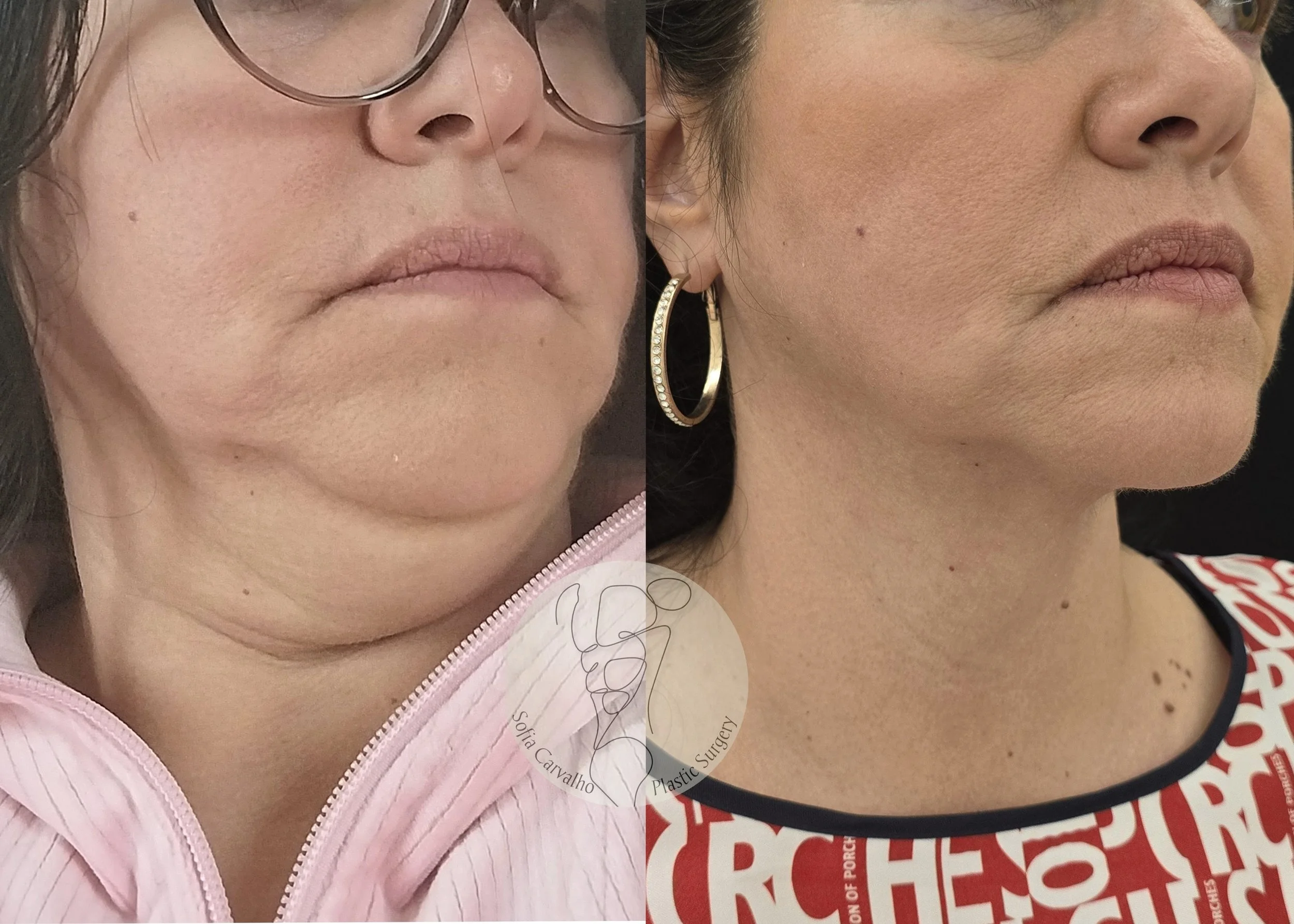 Imagem de uma mulher antes e depois de um procedimento de cirurgia plástica no pescoço e queixo, mostrando a melhora na definição do queixo e na redução do excesso de pele.