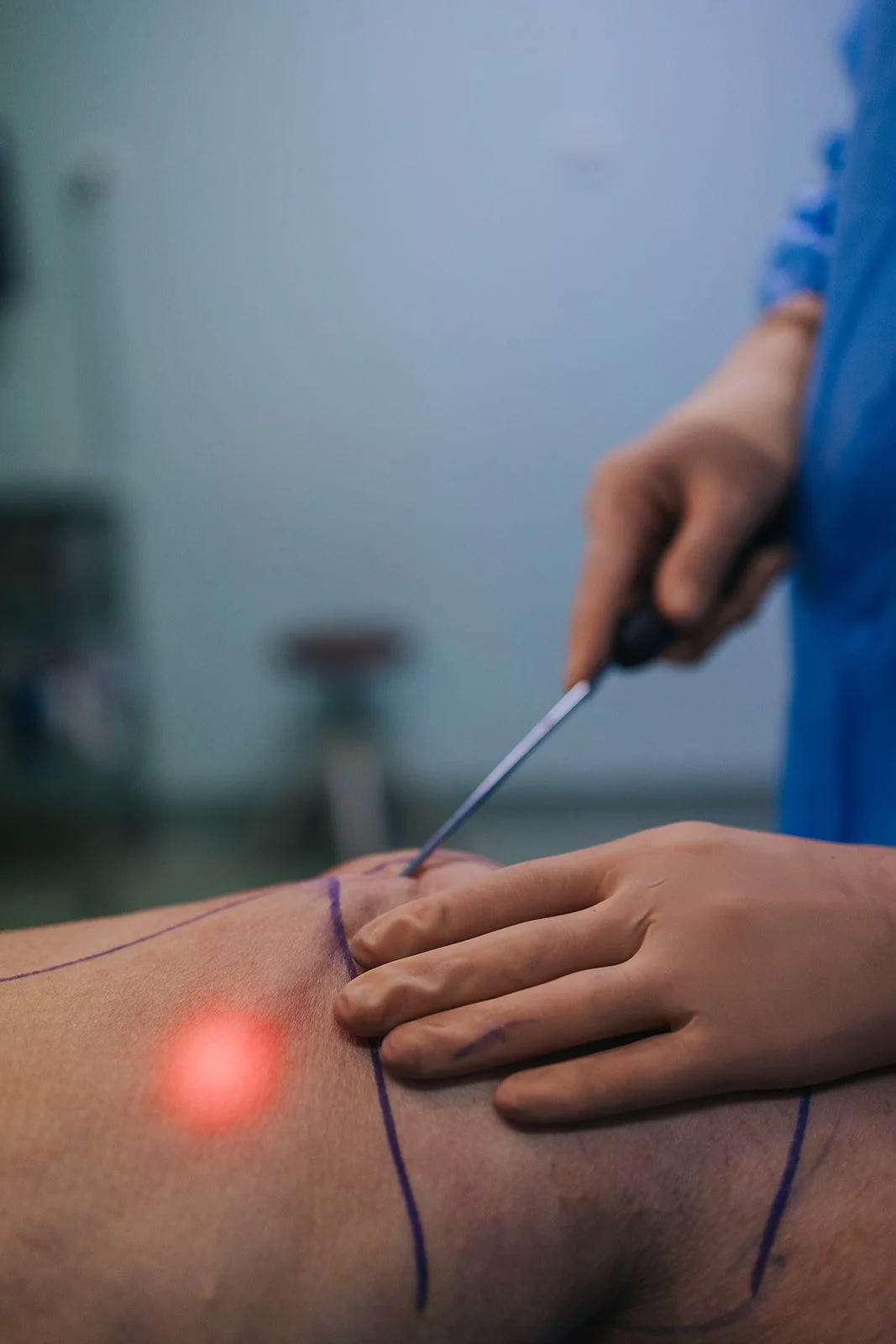 Procedimento médico de inserção de agulha em paciente deitado, com marcações na pele, sob iluminação de laser vermelho