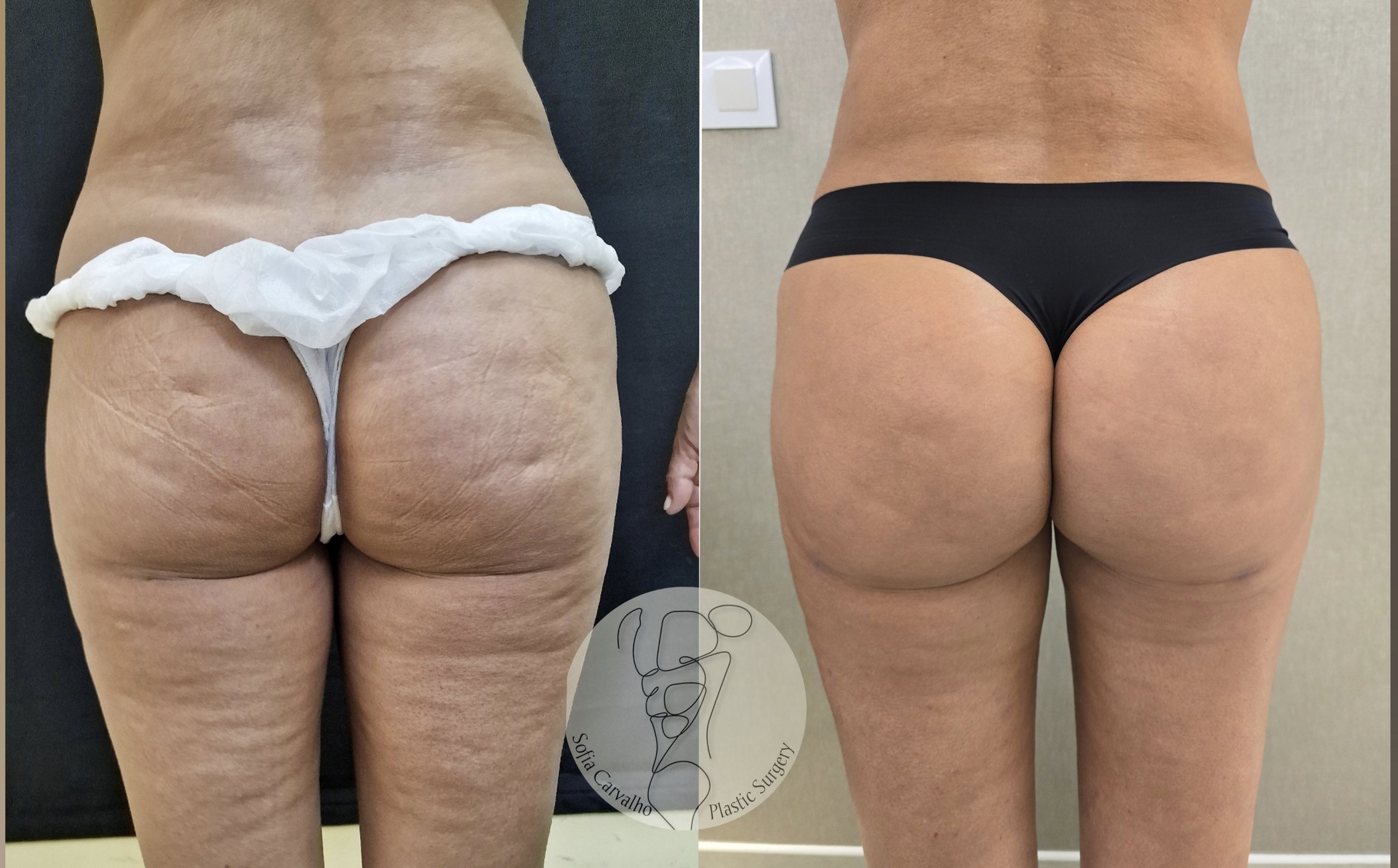 aumento de glúteos antes e depois