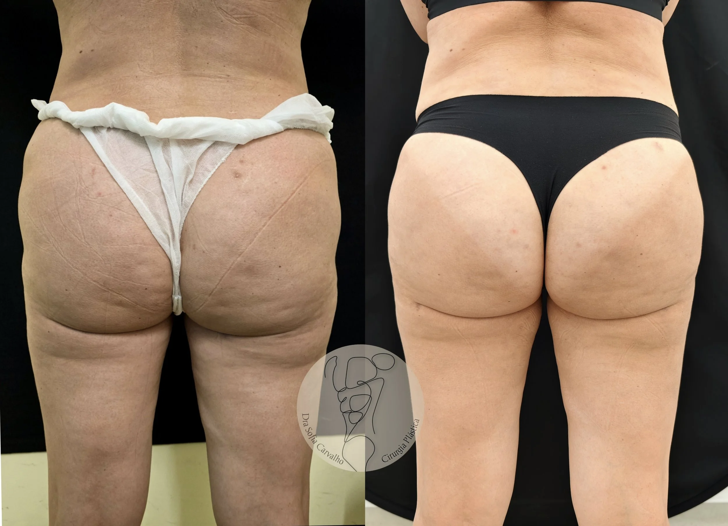 antes e depois remodelação de glúteos