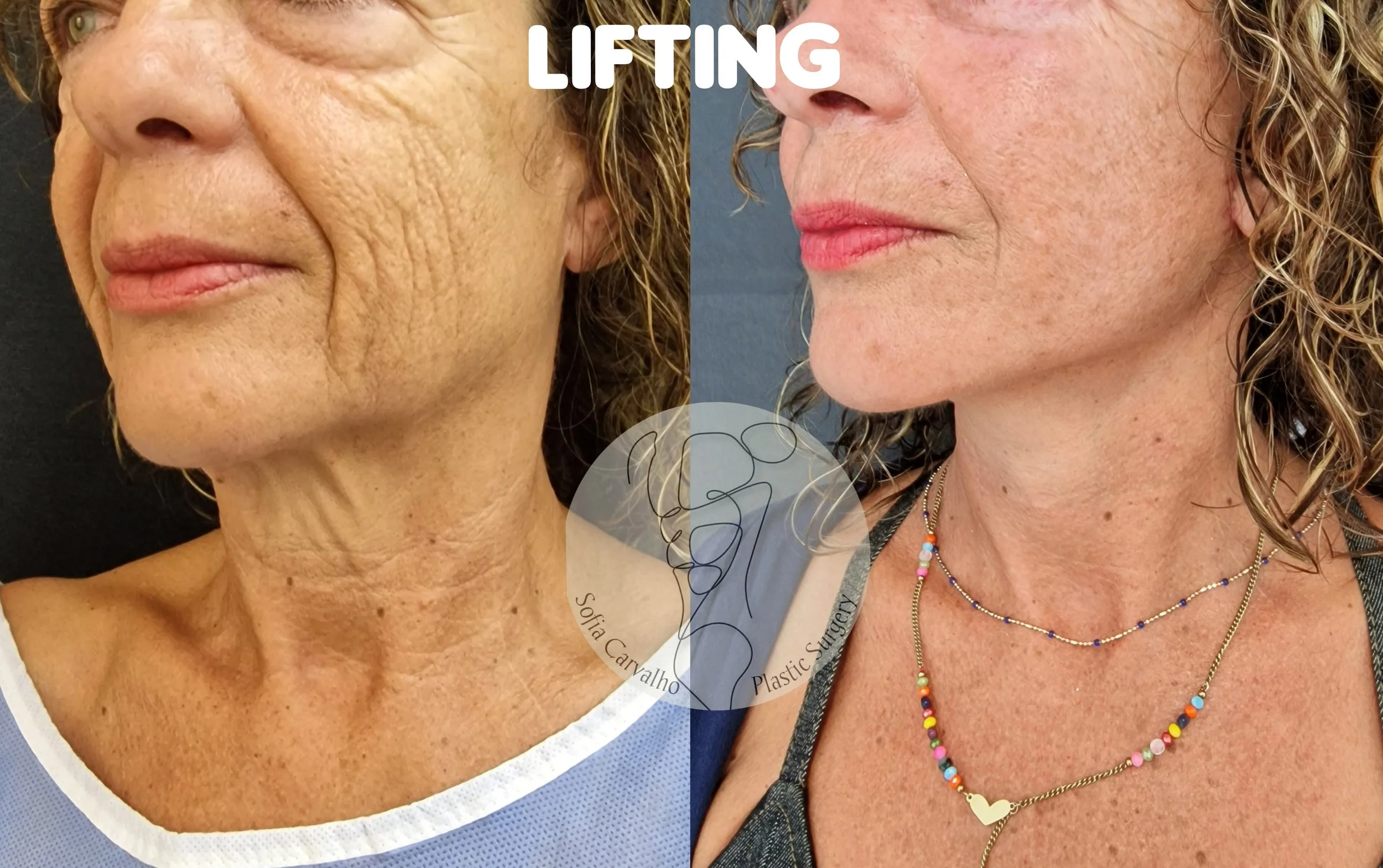 antes e depois facelift