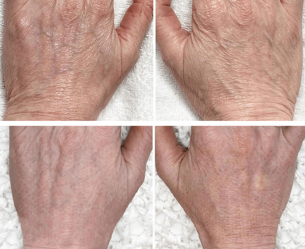Plasma fusion treatment hands