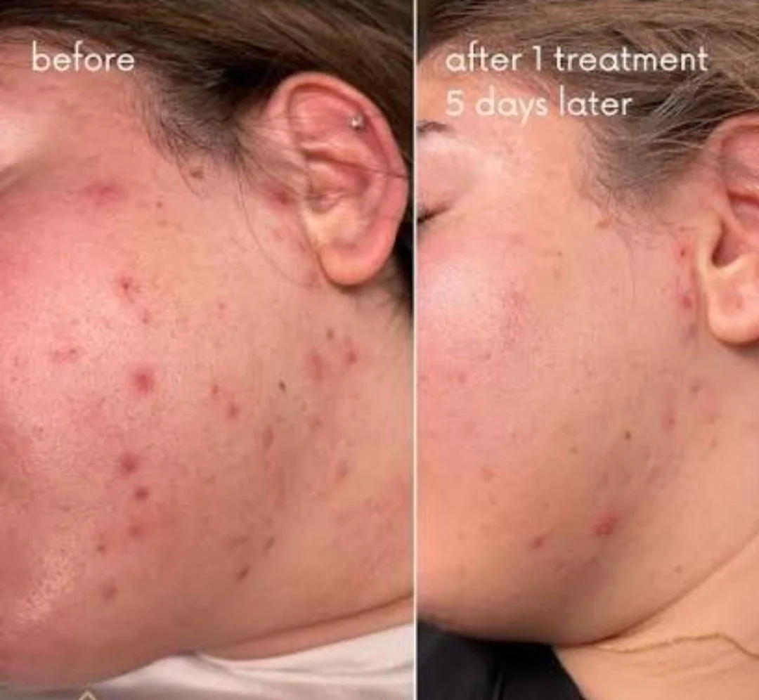 Cold plasma fusion acne treatment face