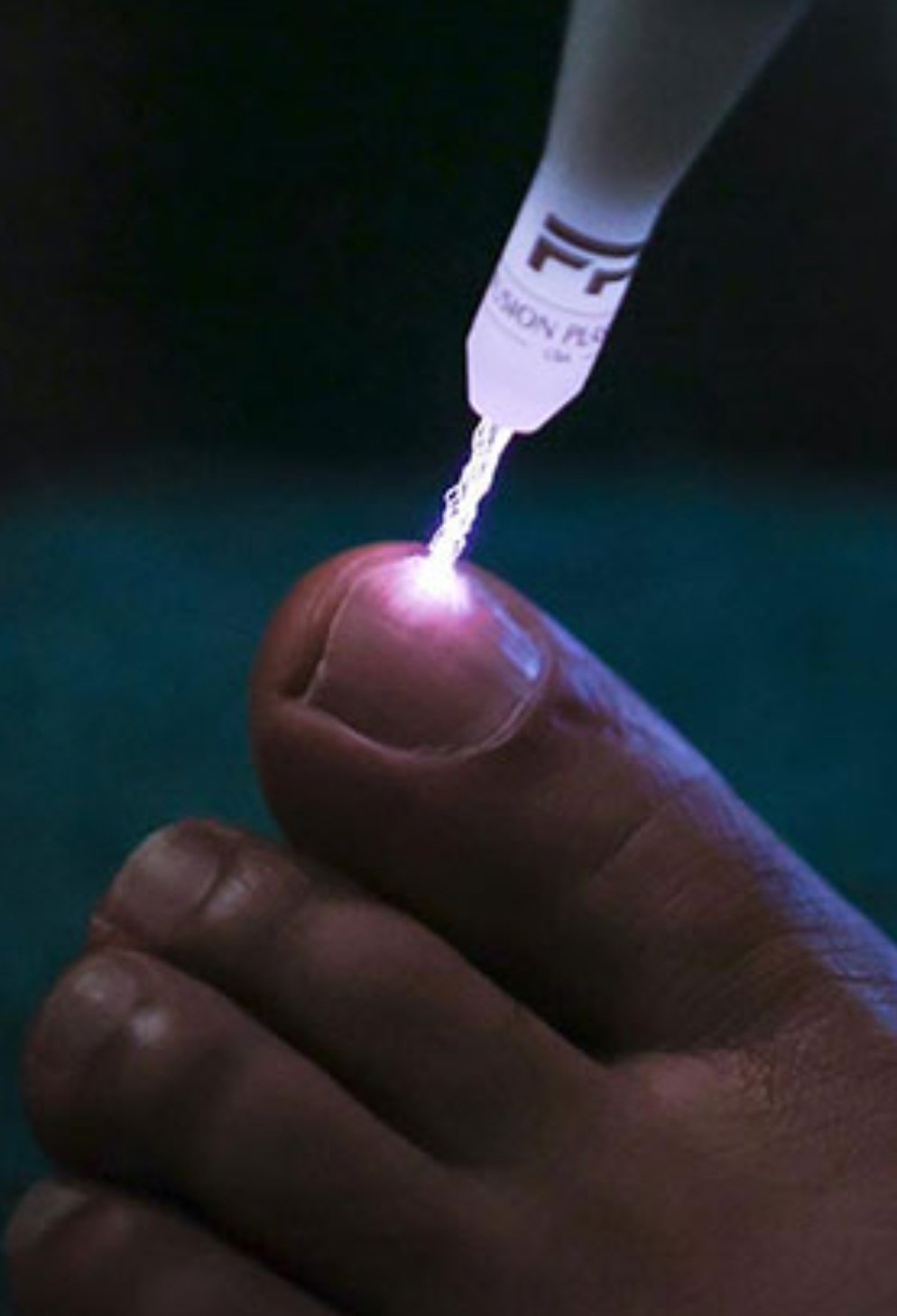 Plasma fusion treatment fungal toe nails