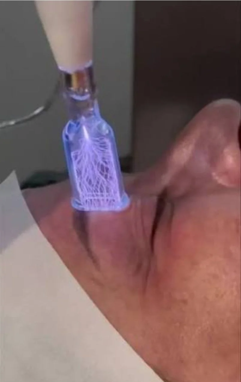 Plasma fusion non surgical upper eye lift