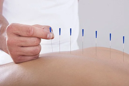 acupuncture-pain-relief-complementary-thumb.jpg