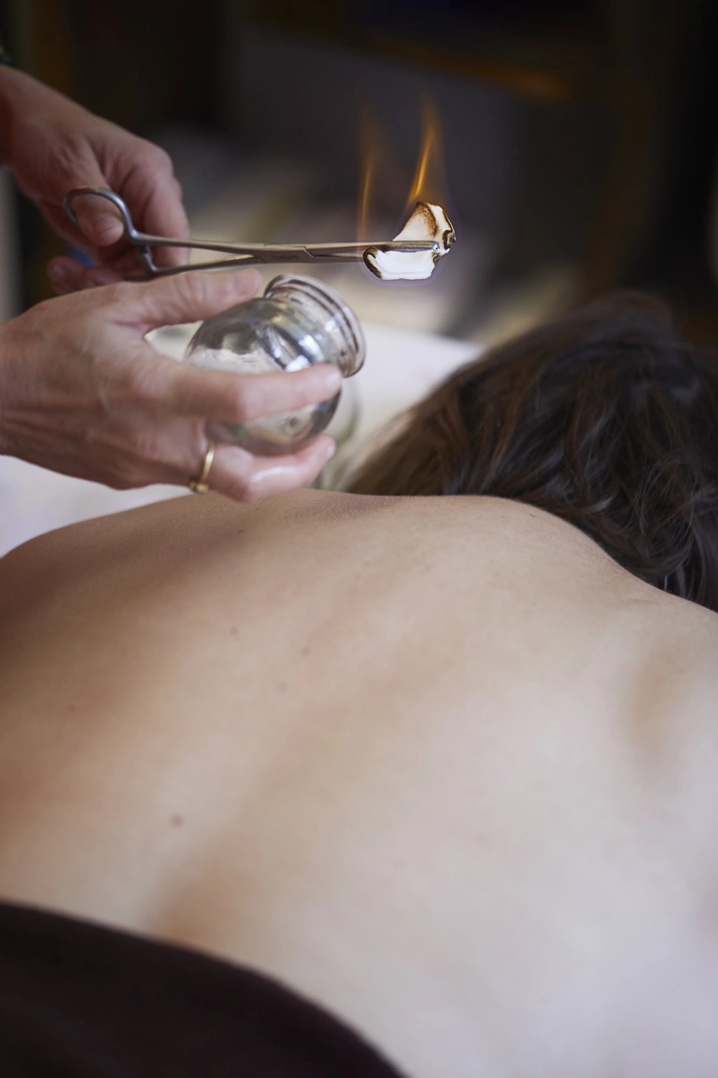 Person receiving cupping therapy on their back in a wellness setting.
