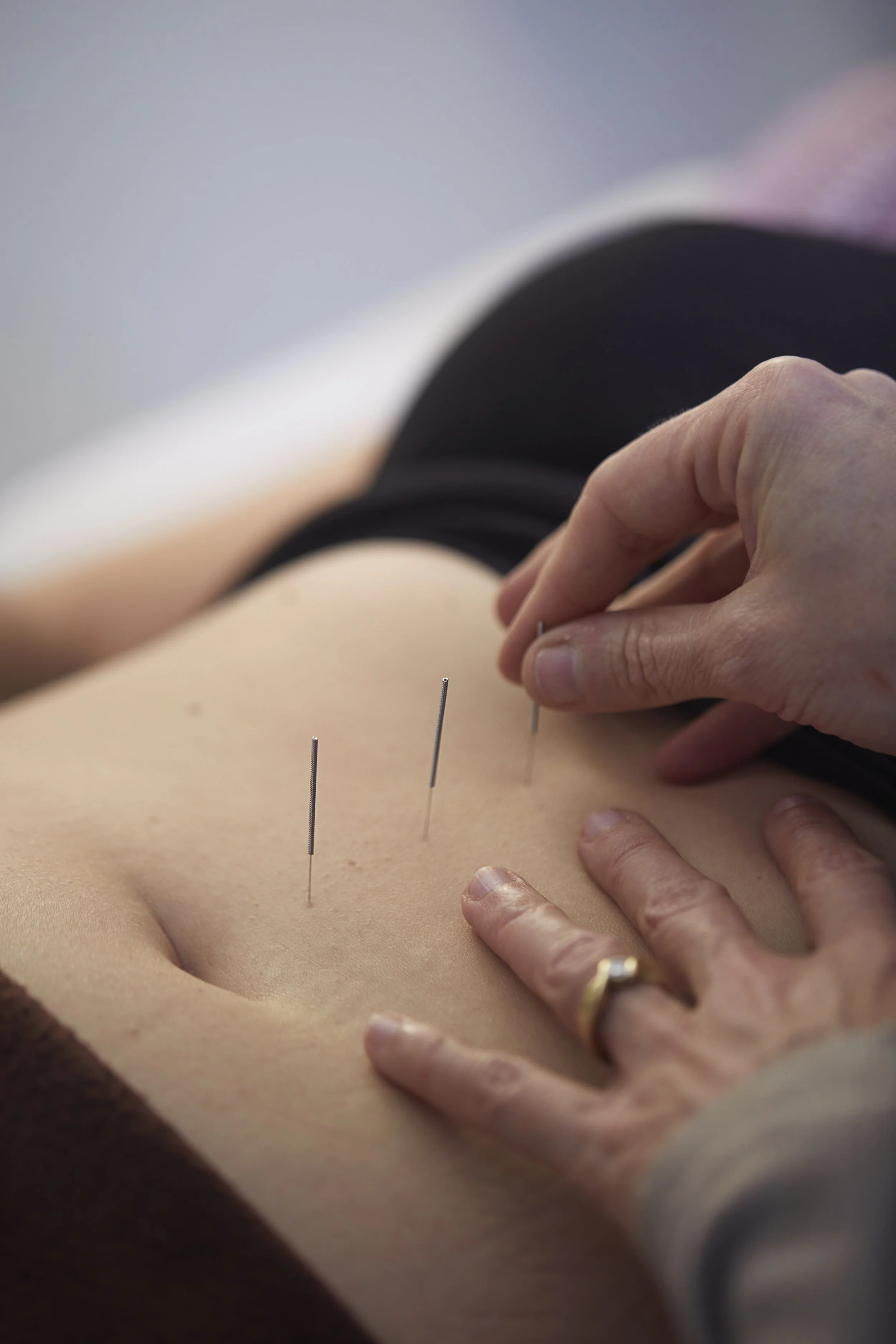 Person receiving acupuncture treatment with thin needles inserted into their abdomen.