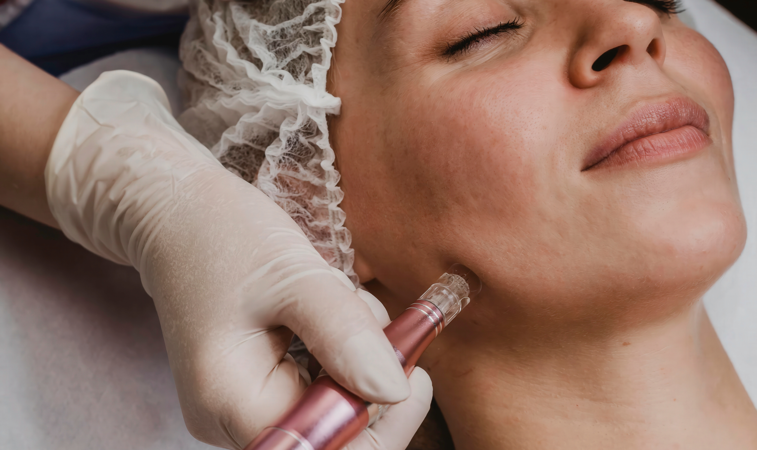 Medspa in Naperville, IL, 60563 Microneedling Near Me