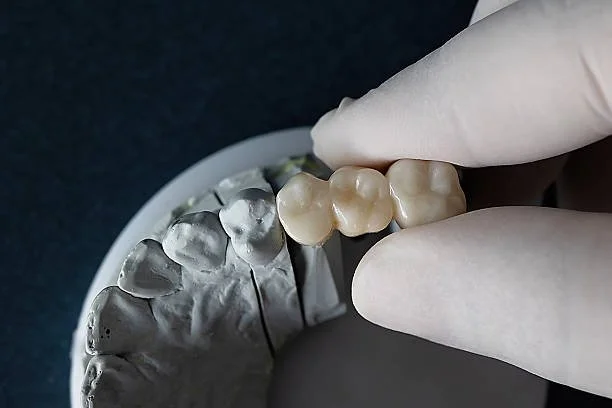 Which Type of Dental Bridge Is Right for You? Traditional, Cantilever, Maryland, and Implant-Supported Bridges in Germantown, TN