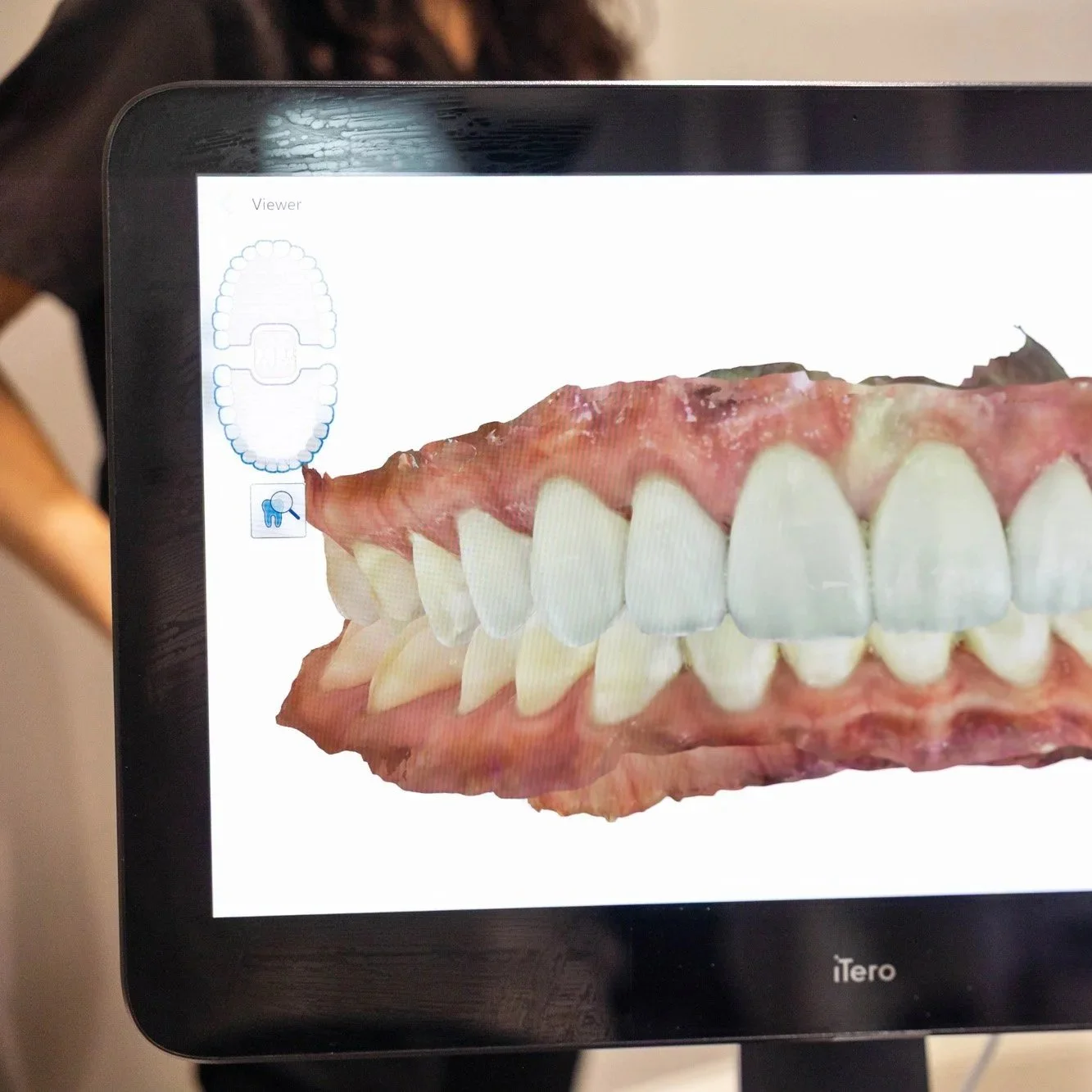 Digital dental scanner showing a 3D model of a set of teeth with upper and lower jaws.