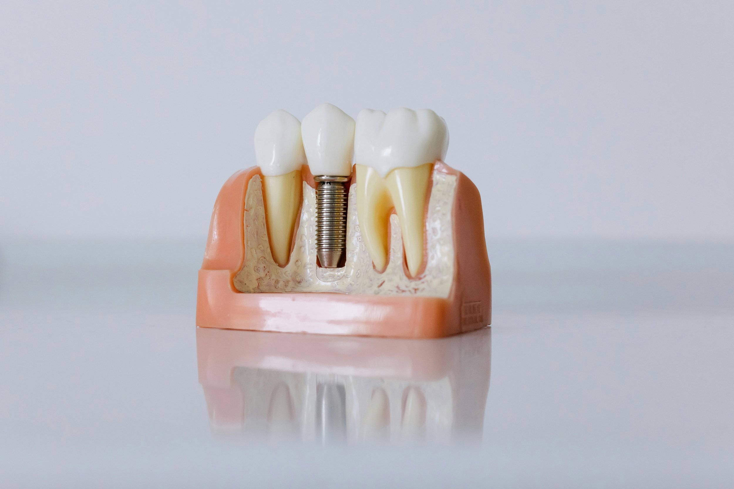 How much do dental implants cost in Tijuana, Mexico? (2026 Guide)