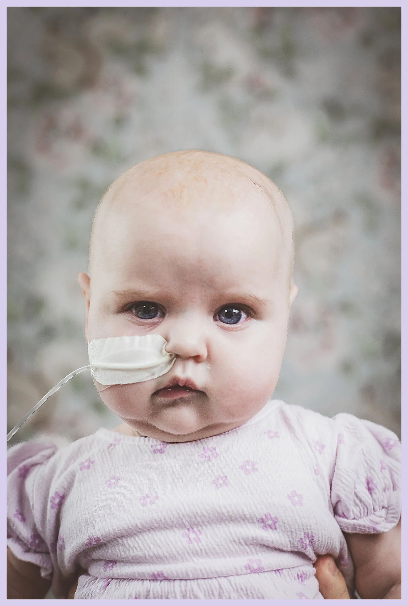 A young girl with a bald head and blue eyes is looking at the camera. She has a tube in her nose, likely for medical support, and is wearing a pink dress with purple flowers.