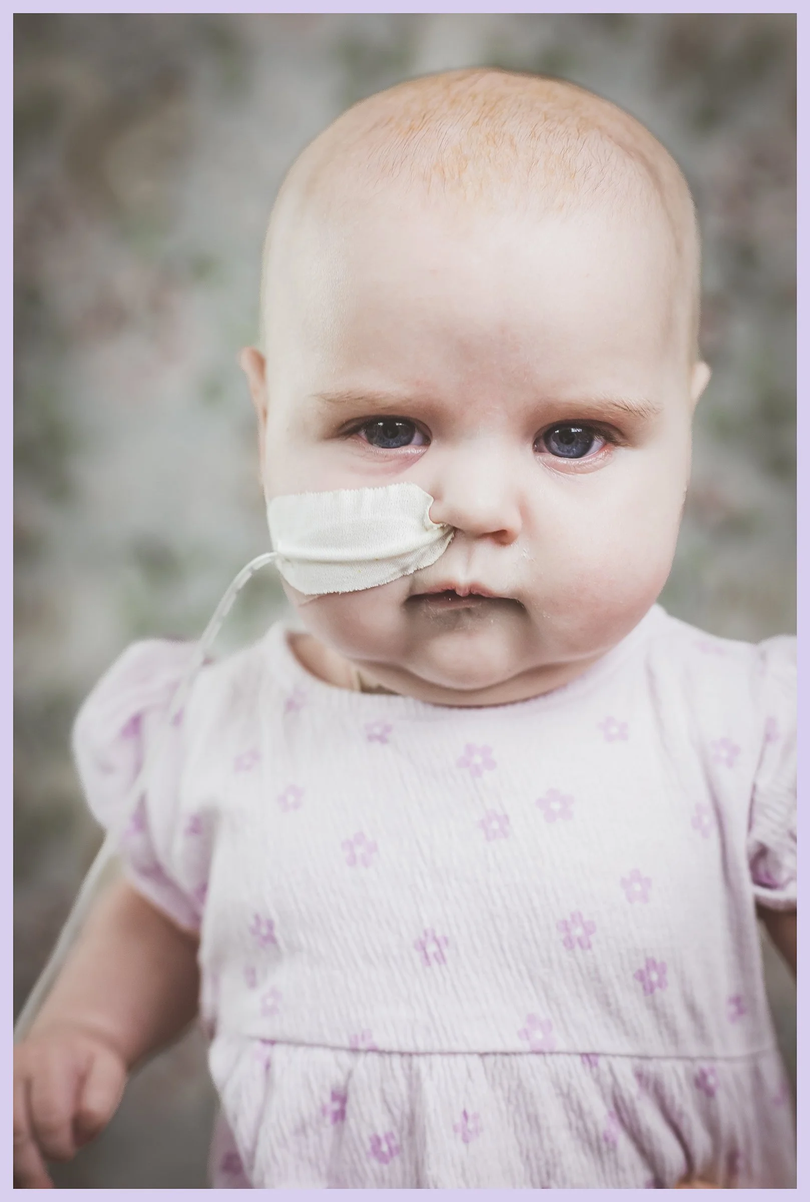 Close-up of a young girl with a serious expression, has a nasal feeding tube taped to her face, wearing a pink dress with purple floral pattern, outdoors.