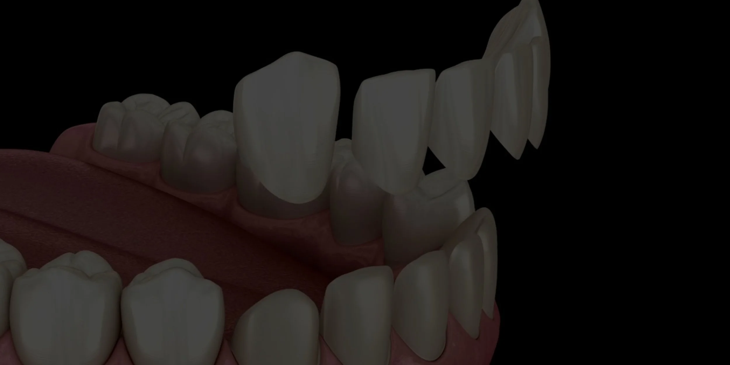 Composite Veneers.jpg