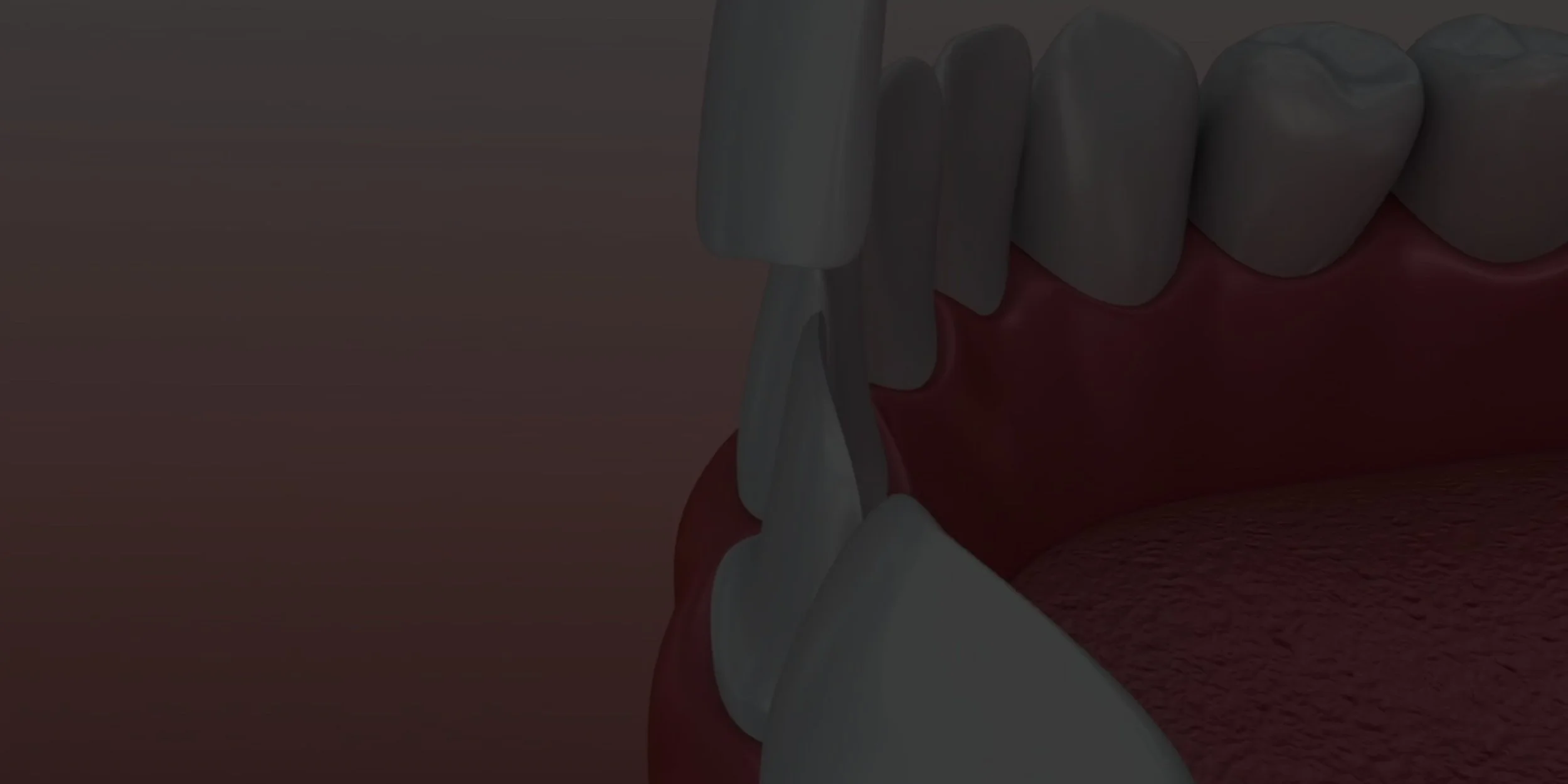 Composite Veneers (1).jpg
