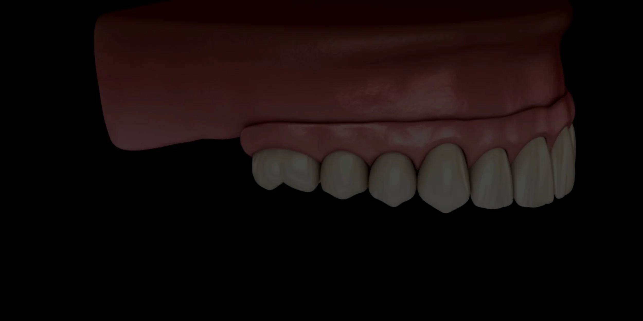 All on 4 Dental Implants.jpg