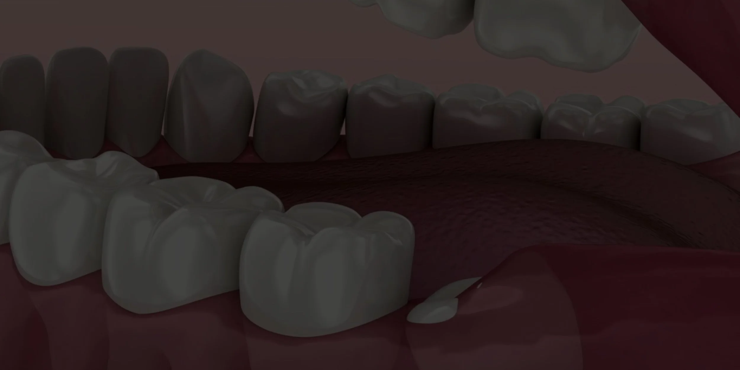 Wisdom Tooth Extraction.jpg