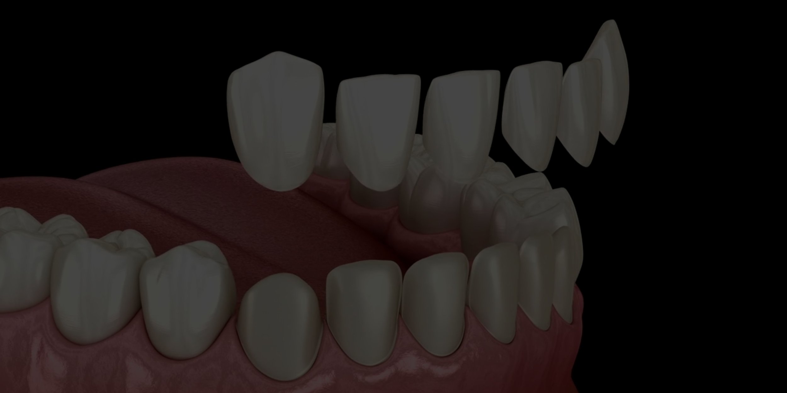 Porcelain Veneers (1).jpg